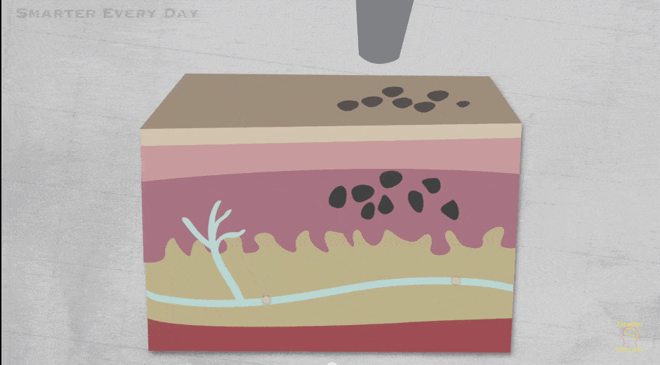 The Risks of “Alternative” Tattoo Removal