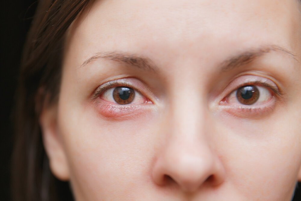 I have a stye on my eye, can I still do lash extensions?