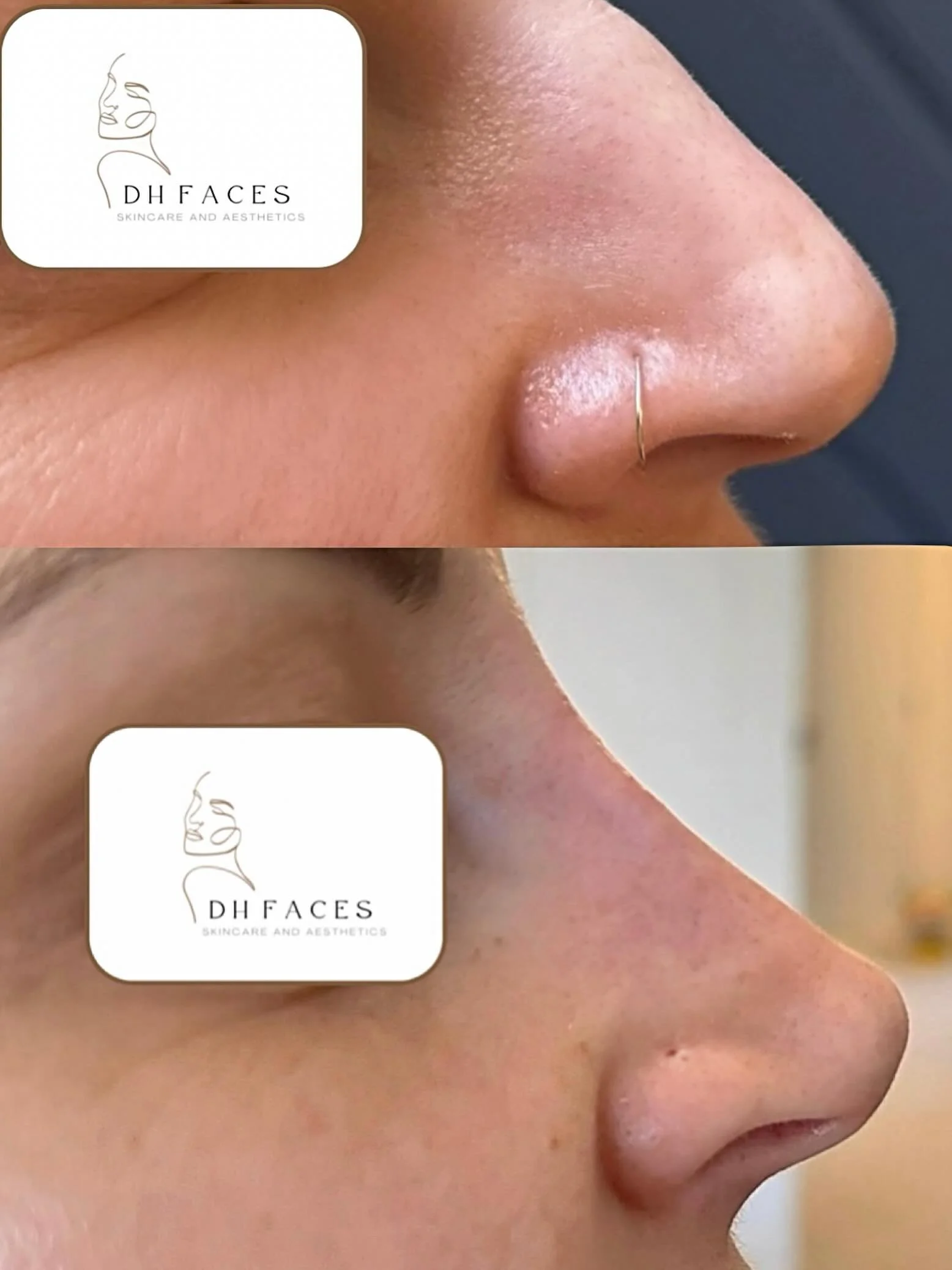 NON SURGICAL RHINO 👃🏻 beautiful improvement for a beautiful client. Tip lifting and dorsal straightening. BEST one yet!
💖#LiquidRhinoplasty
💖 #NonSurgicalRhinoplasty
💖#NoseFiller
💖#FacialBalancing
💖BeforeAndAfter
