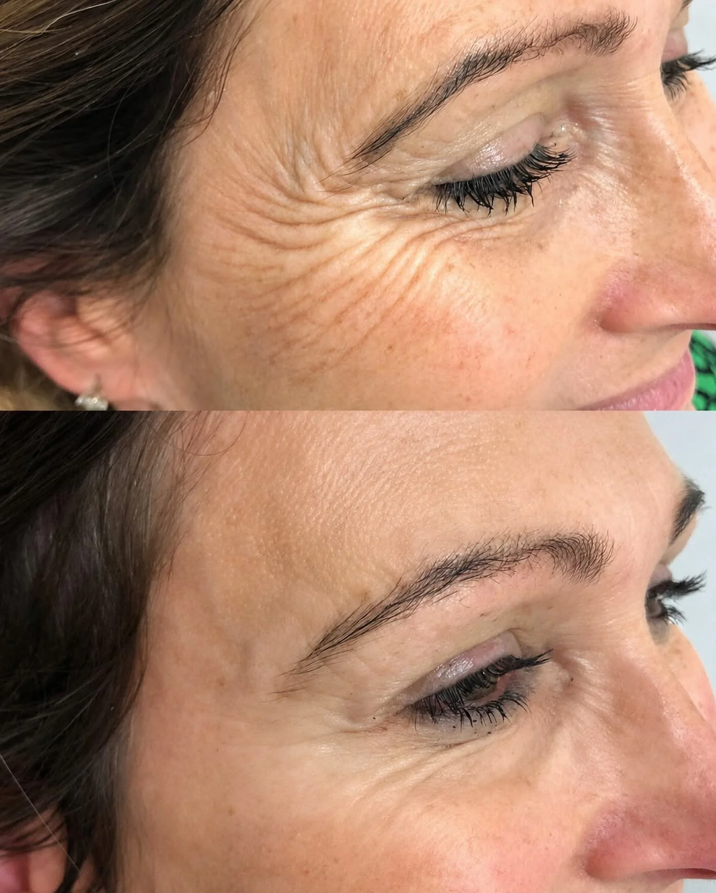 Crows feet vanished. Full orbital spread. This client&rsquo;s previous wrinkles were forming into her eye brows before 💉🪄Lovely results! &hellip; #skincare
#Aesthetics
#glowingskin
#medicalaesthetics
#antiaging