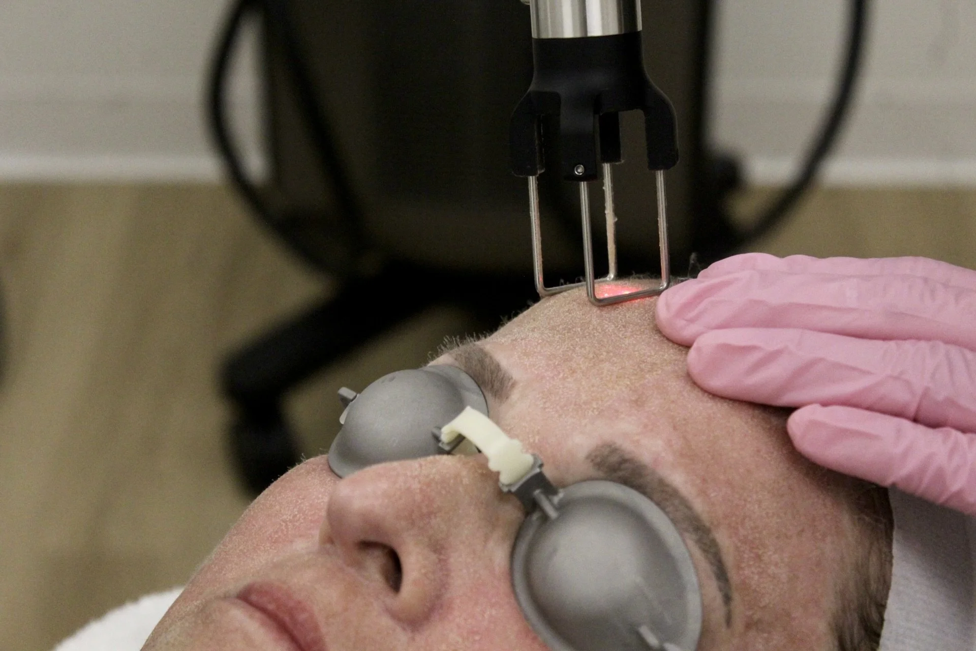 Client receiving CO2 laser skin resurfacing treatment for wrinkles, texture, and skin rejuvenation