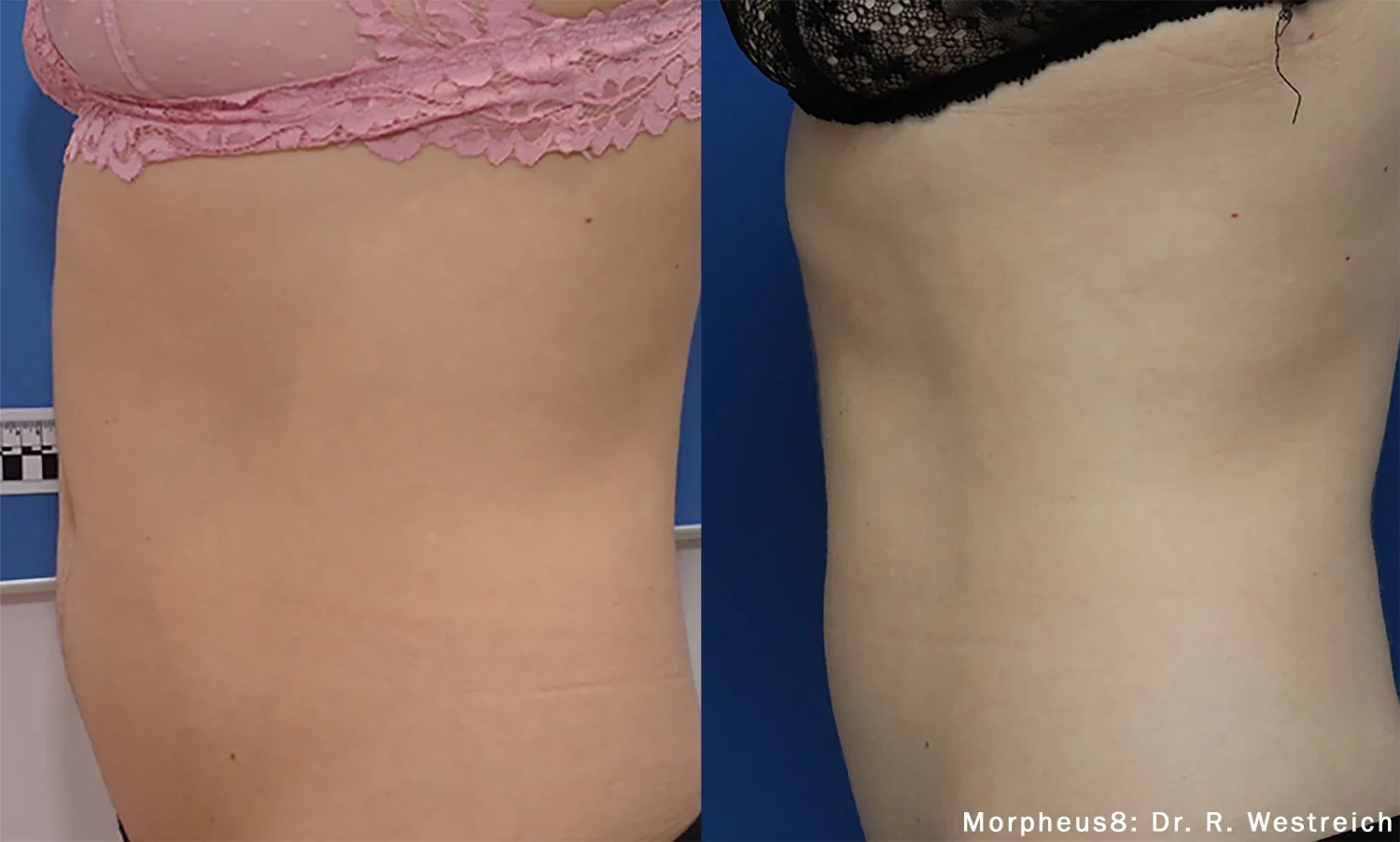 morpheus8-before-after-dr-r-westreich-preview-1.jpg