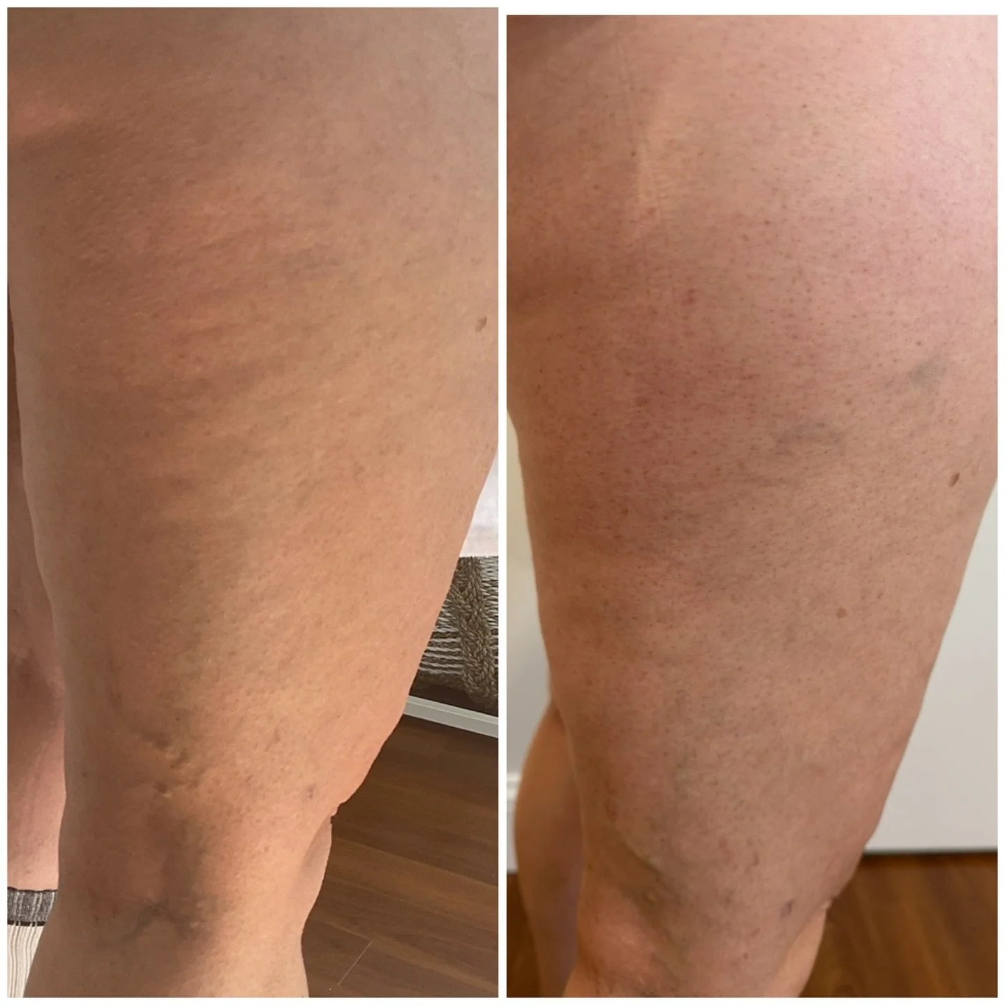 This is what non-invasive, fat reduction and cellulite reduction treatment can look like 🤩

We are always so impressed with the results, we know you will be too. It may not be the first step when you have a lot of extra weight to lose, but it is a f