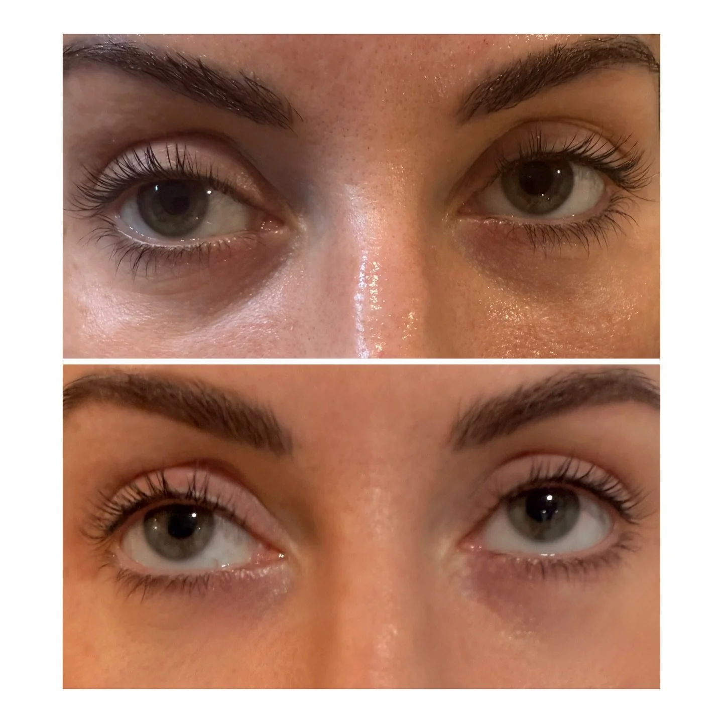Before &rarr; After ✨

We used microneedling paired with Ariessence PDGF and customized skin boosters to stimulate collagen where the skin is most delicate and needs it most.

The results:

&bull; Under-eye hollows + dark circles softened
&bull; Smoo