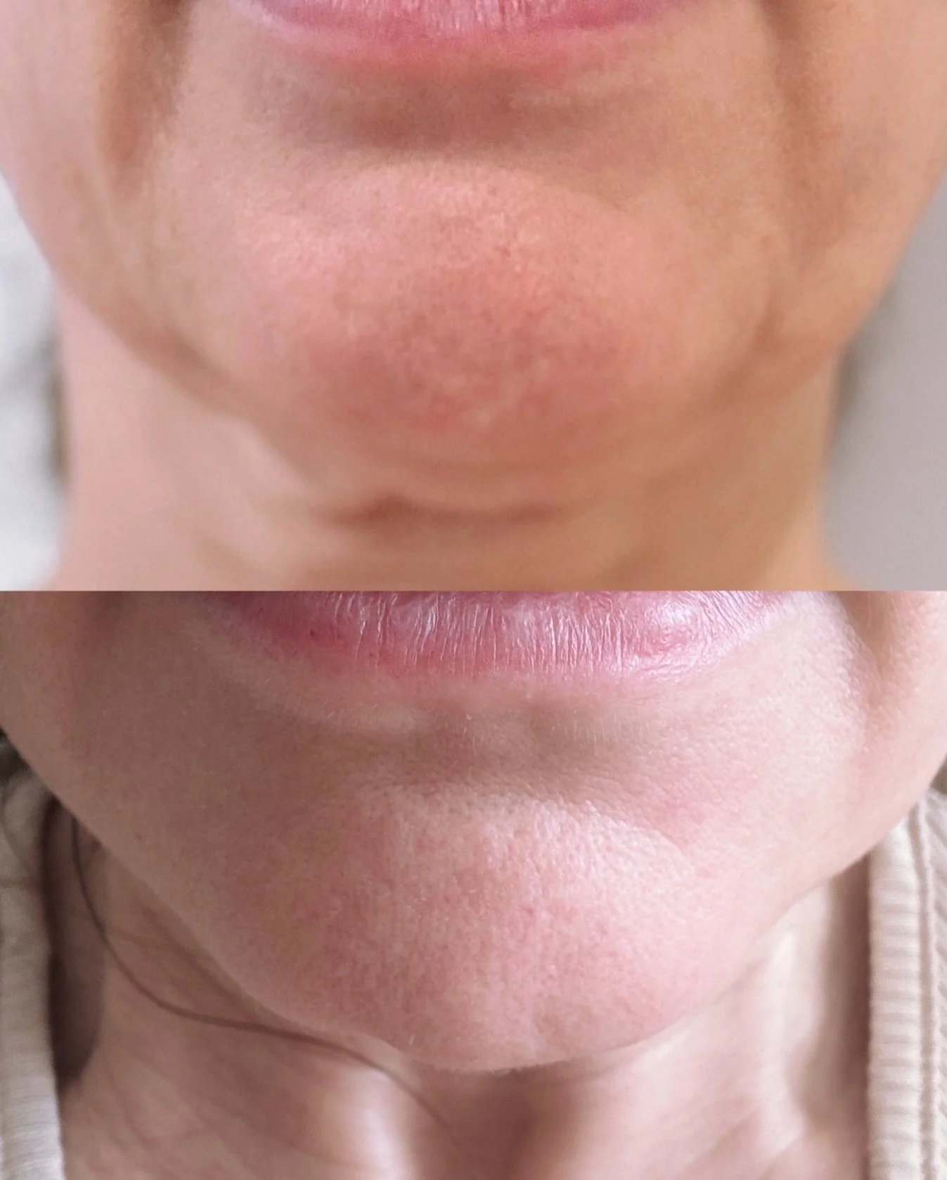 Jowls showing up? As we age, certain muscles begin to pull downward and give that sagging jawline appearance.

It&rsquo;s not always about adding filler. Sometimes it&rsquo;s about strategic muscle relaxation. 

This is just 5 DAYS after treating the