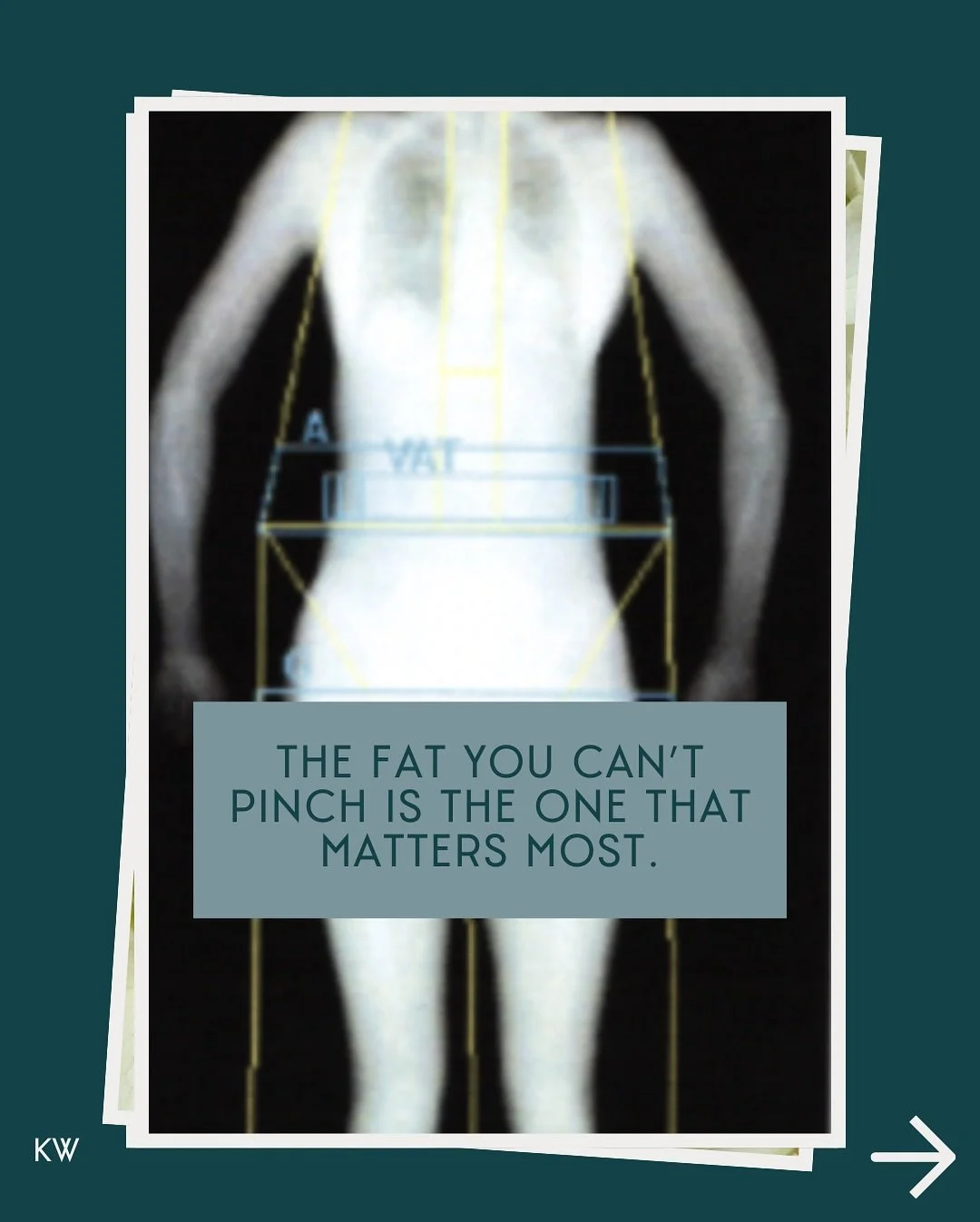 Most people think of a DEXA scan as a bone test. 

True &mdash; but it can also measure body composition and the hidden fat you can&rsquo;t see.

At 41, I decided to get one for myself. I wanted a baseline and I wanted to know firsthand what my clien