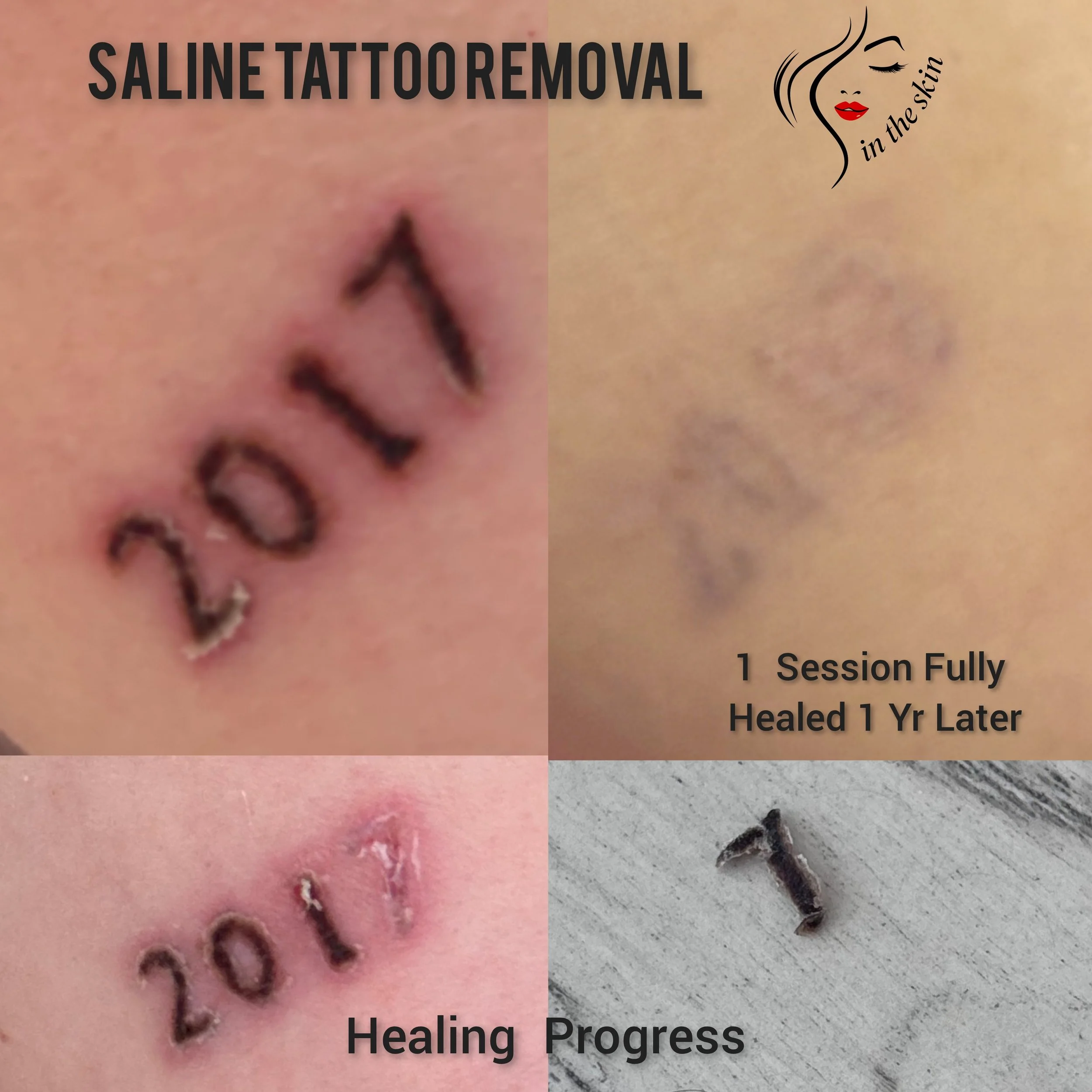 Image shows a body tattoo that has been lightened significantly in only 1 session along with healing progress where the number 7 has fallen off pulling color out of the skin