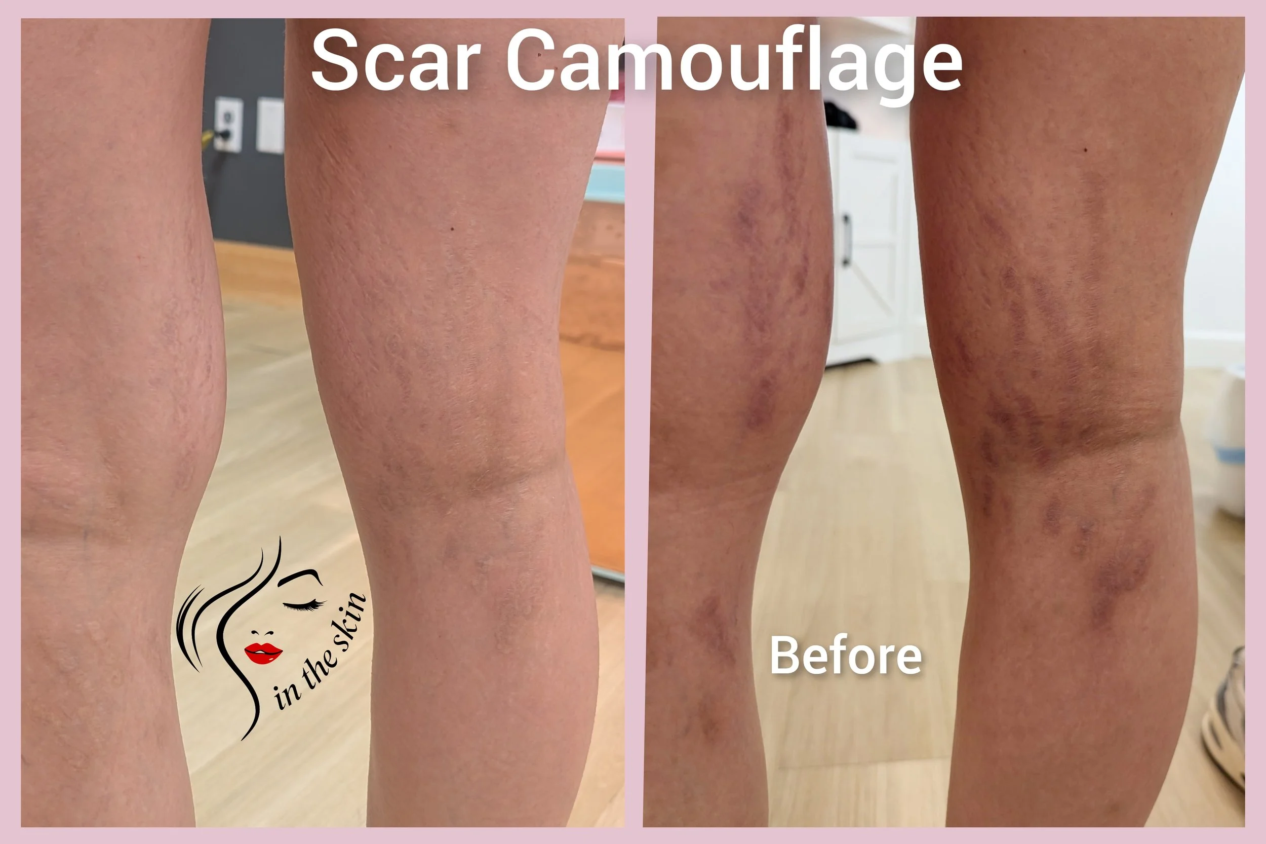 Before Pic shows extensive dark scarring running down the back of legs. After shows beautifully healed and scarring is camouflaged