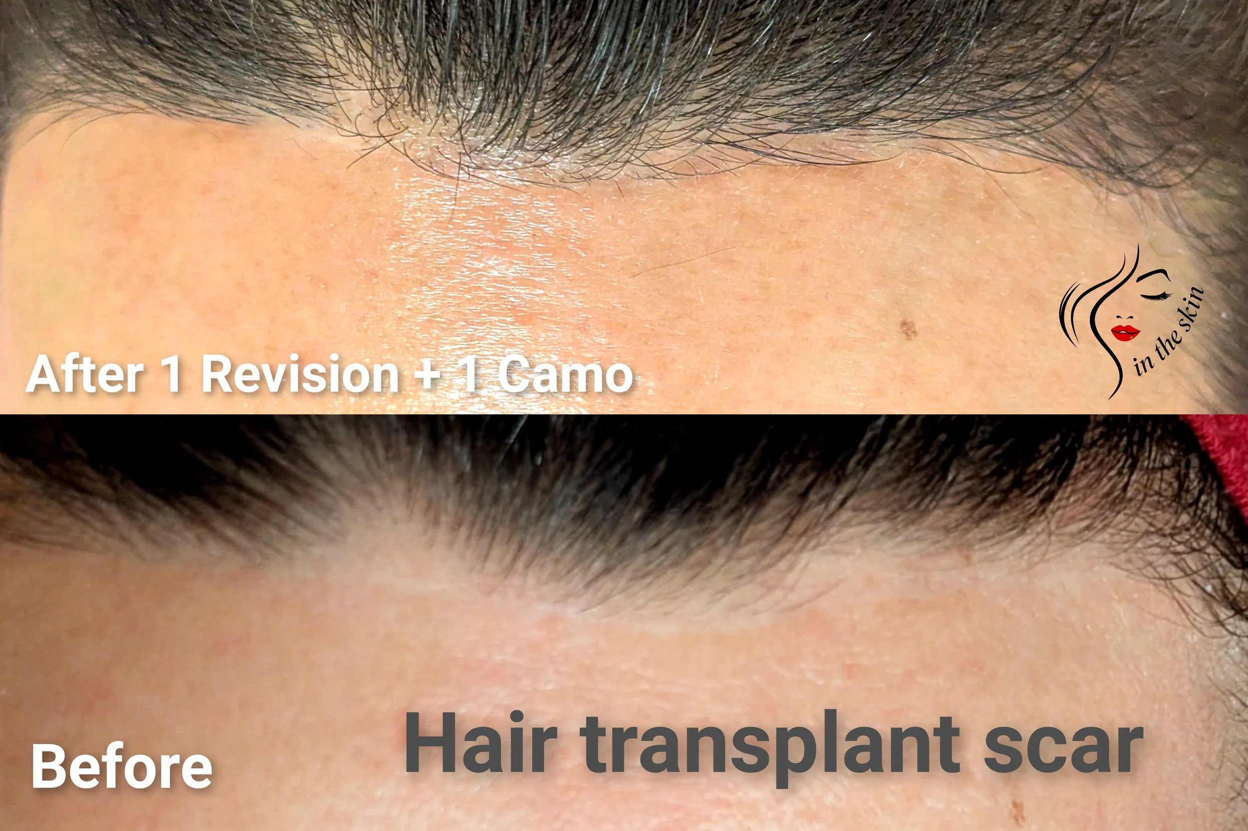 Image shows Hair transplant scar before and after 1 revision + 1 Camouflage appointment where the scar is invisible