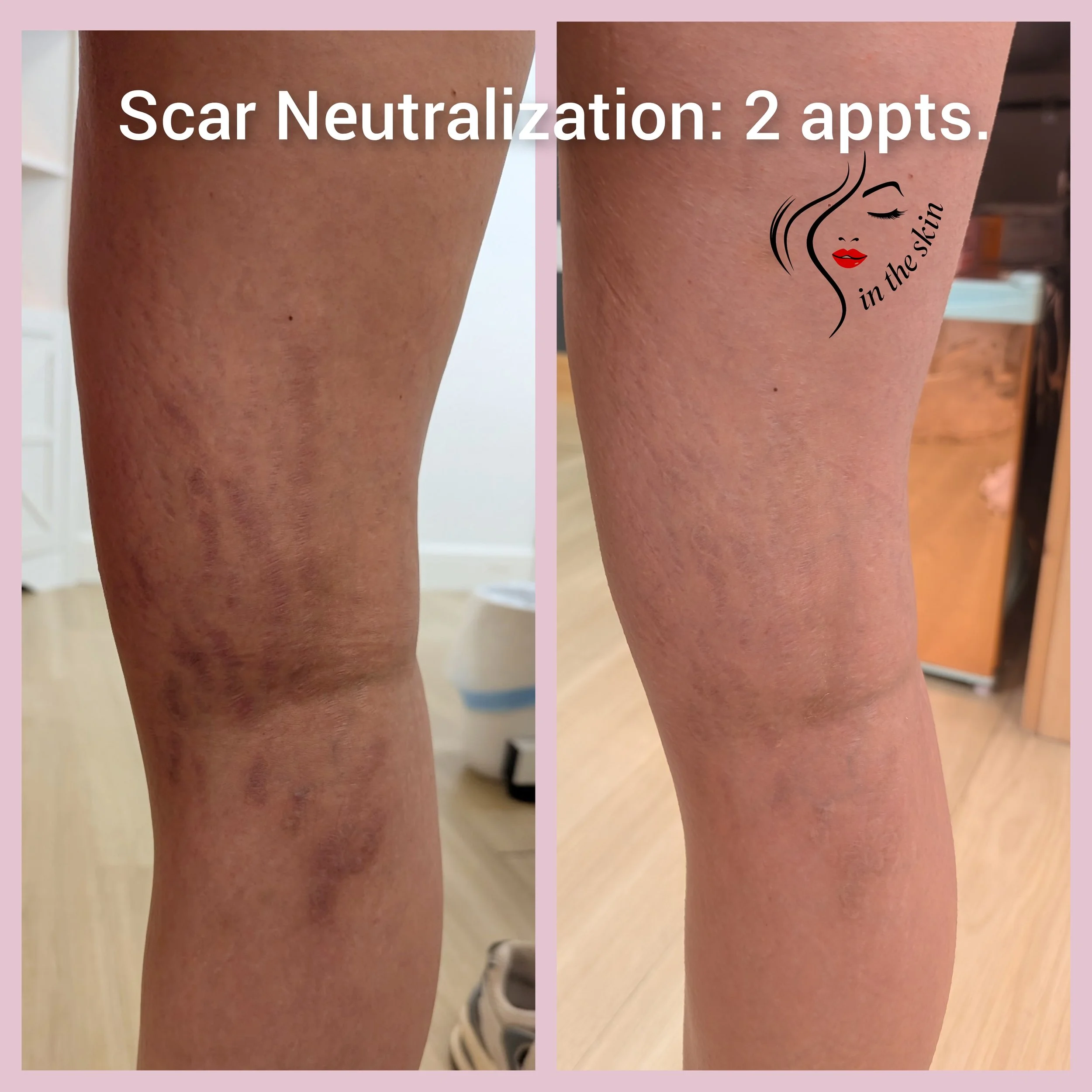 Picture shows Scar Camouflage (or neutralization with dark scars) that are barely visible after 2 appointments