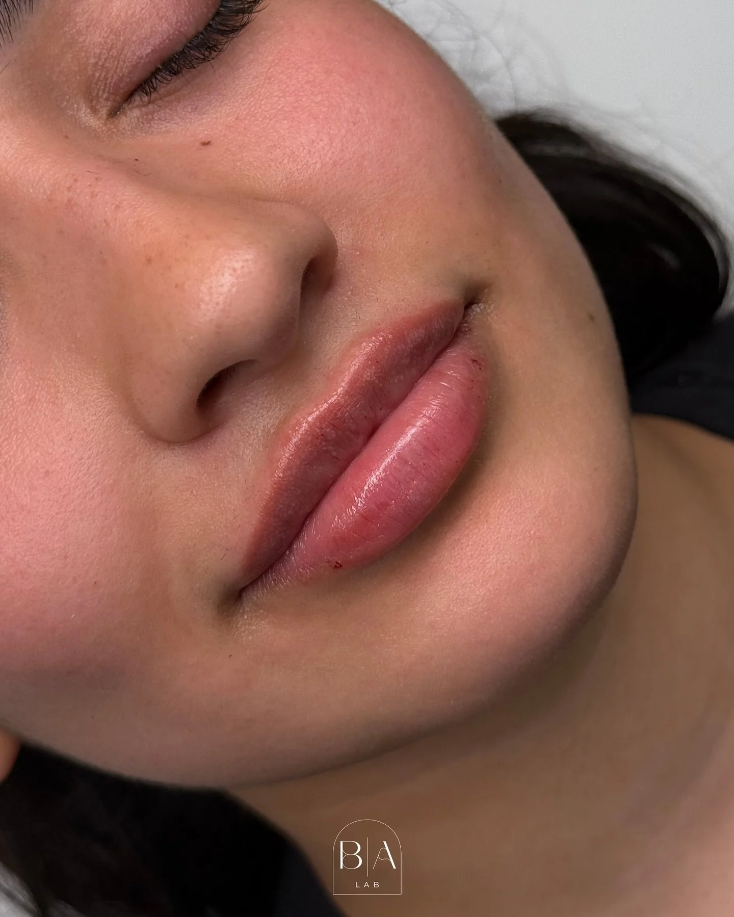 A little half syringe moment, because subtle is stunning✨

BALANCE AESTHETIC LAB🌿✨ 
Medical Wellness Spa | San Antonio, Tx
210.823.9788
Link in bio for booking &amp; more info &mdash; www.balanceaestheticlab.com

#sanantoniomedspa #sanantoniolipfill