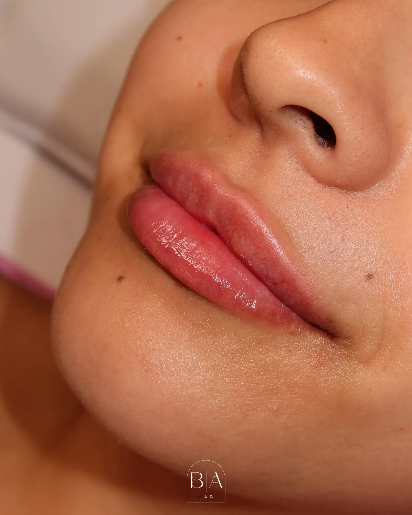 1.0 mL Restylane Kysse💉✨

Restylane Kysse&mdash; The perfect HA filler designed for natural-looking volume, softness, and flexibility that moves with you. 

💫Ready for your lip transformation?

BALANCE AESTHETIC LAB🌿✨ 
Medical Wellness Spa | San A