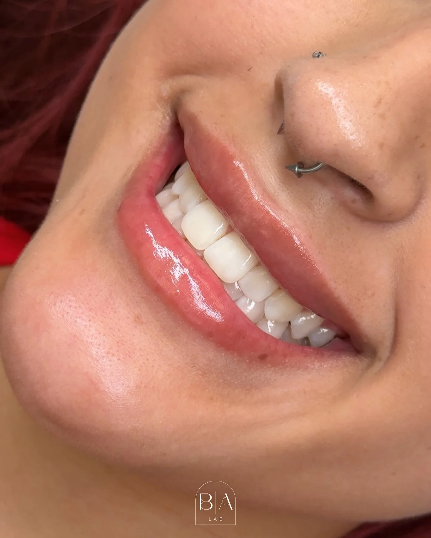 Annual Filler Maintenance - Where less is more💉✨

When done correctly, yearly touch-ups can keep your results fresh, balanced, and natural. But overfilling too often can cause product migration, a loss of shape, or that &ldquo;overdone&rdquo; look t