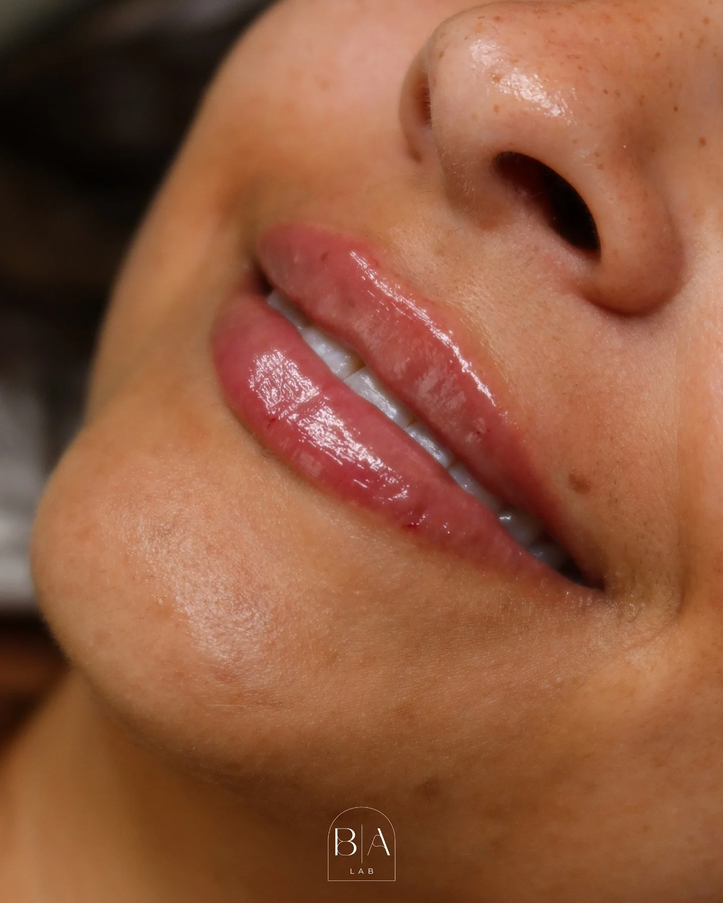 Refined. Balanced. Effortless.✨ 

This transformation softened the natural M-shape into a beautifully symmetrical lip, while keeping the result natural &amp; timeless.

M-shaped lips can create the look of uneven volume or fullness in the center of t