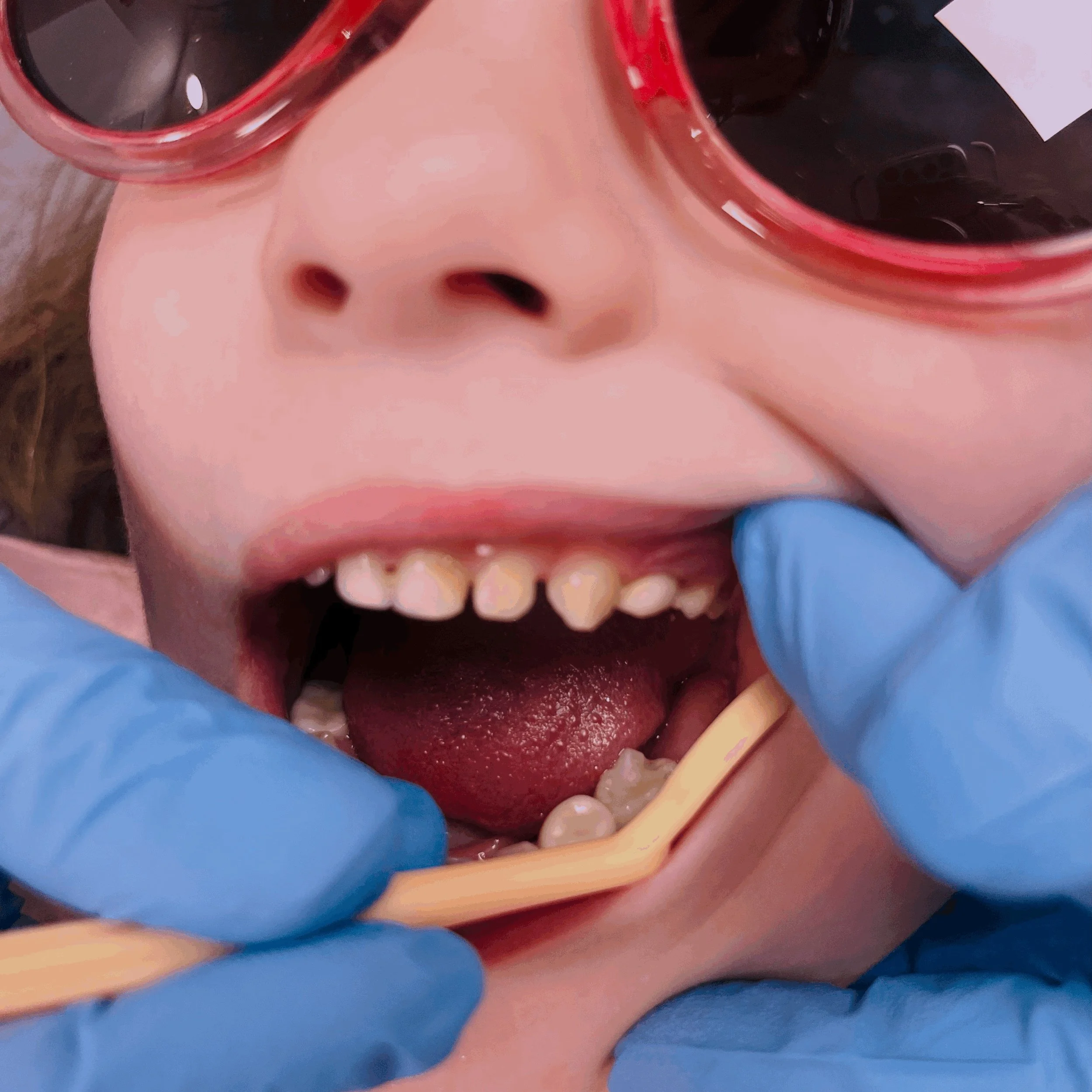 Paediatric Zirconia Dental Crowns: Aesthetic “White Crowns” for Children