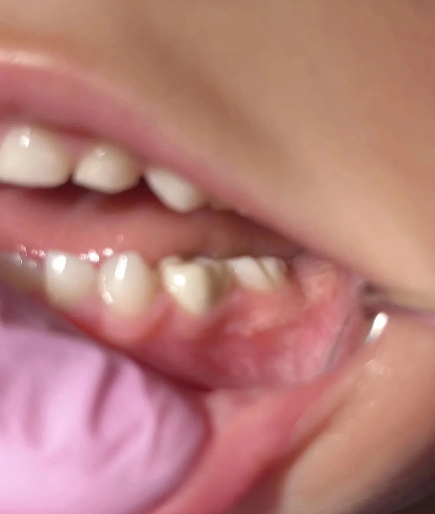 Paediatric white crown on baby molar