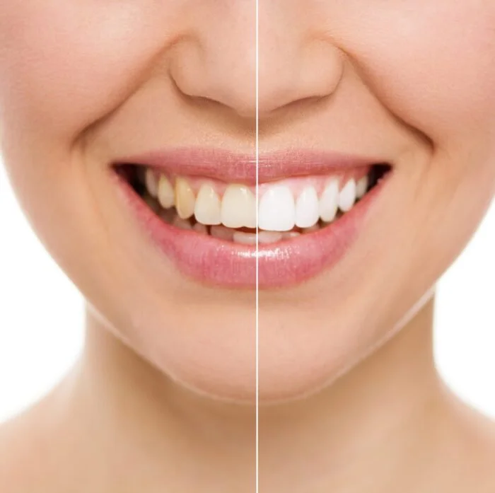 teeth-whitening-in-rogers-ar-700x697.jpg