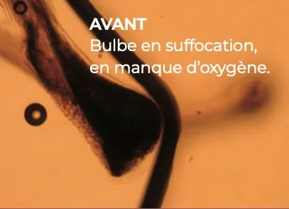 Bulbe capillaire qui manque d'oxygène