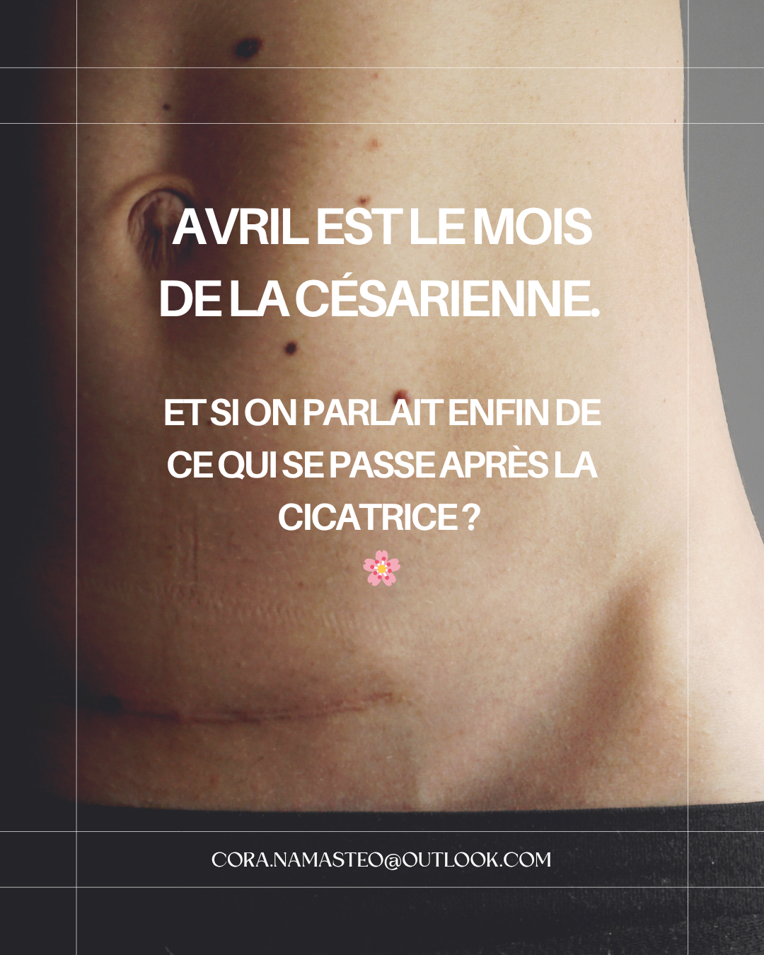 Césarienne : Au-delà de la cicatrice, la science du mouvement et du soin manuel