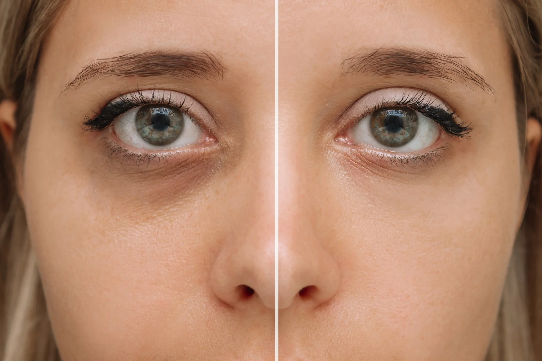 Bright Eyes, Smart Science: Addressing Under-Eye Circles