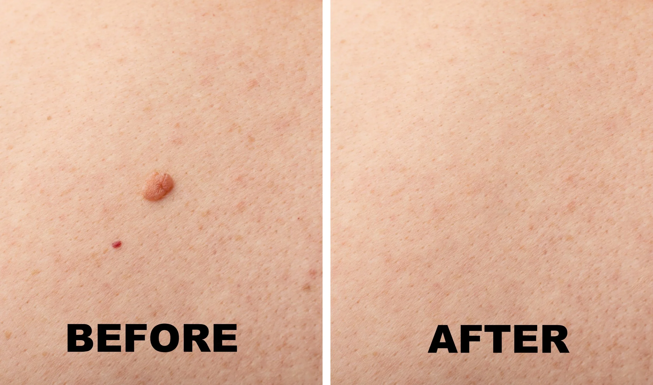 Skin Tags, Red Dots and Bumps, Gone in Minutes: Meet the Bovie