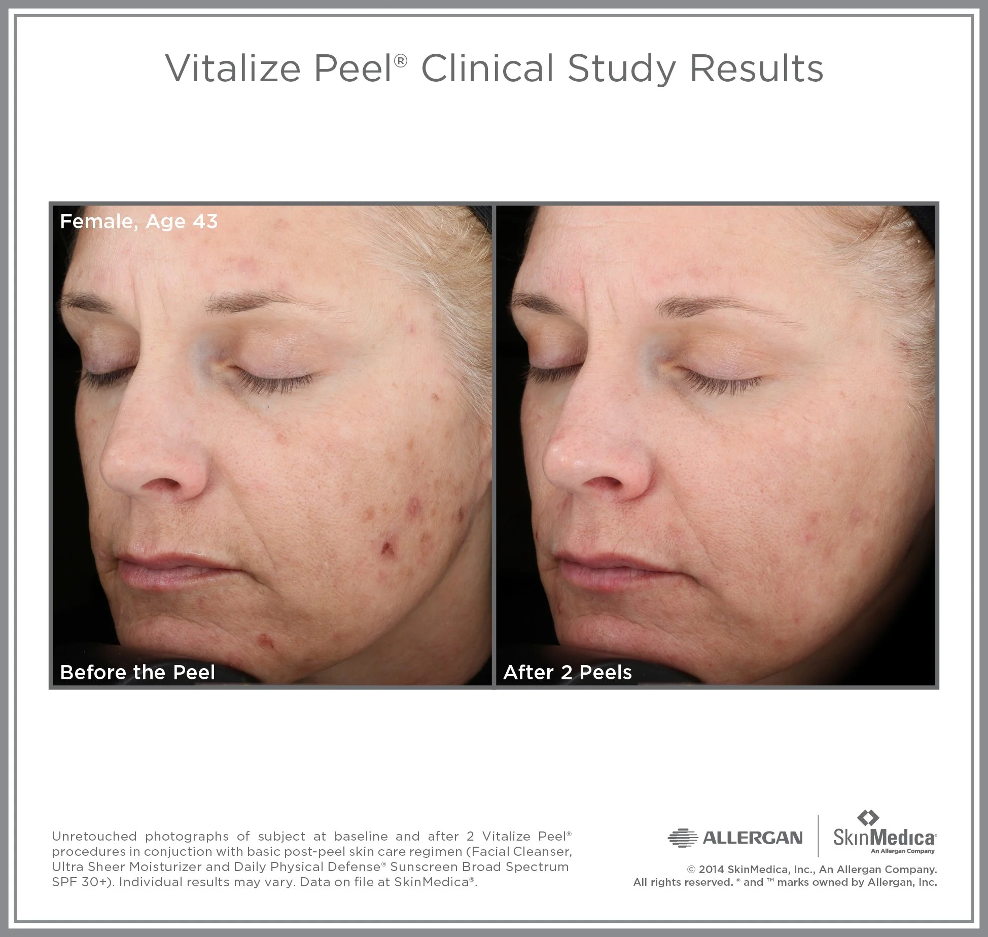 Vit_Peel_CS_Female_Age43.jpg