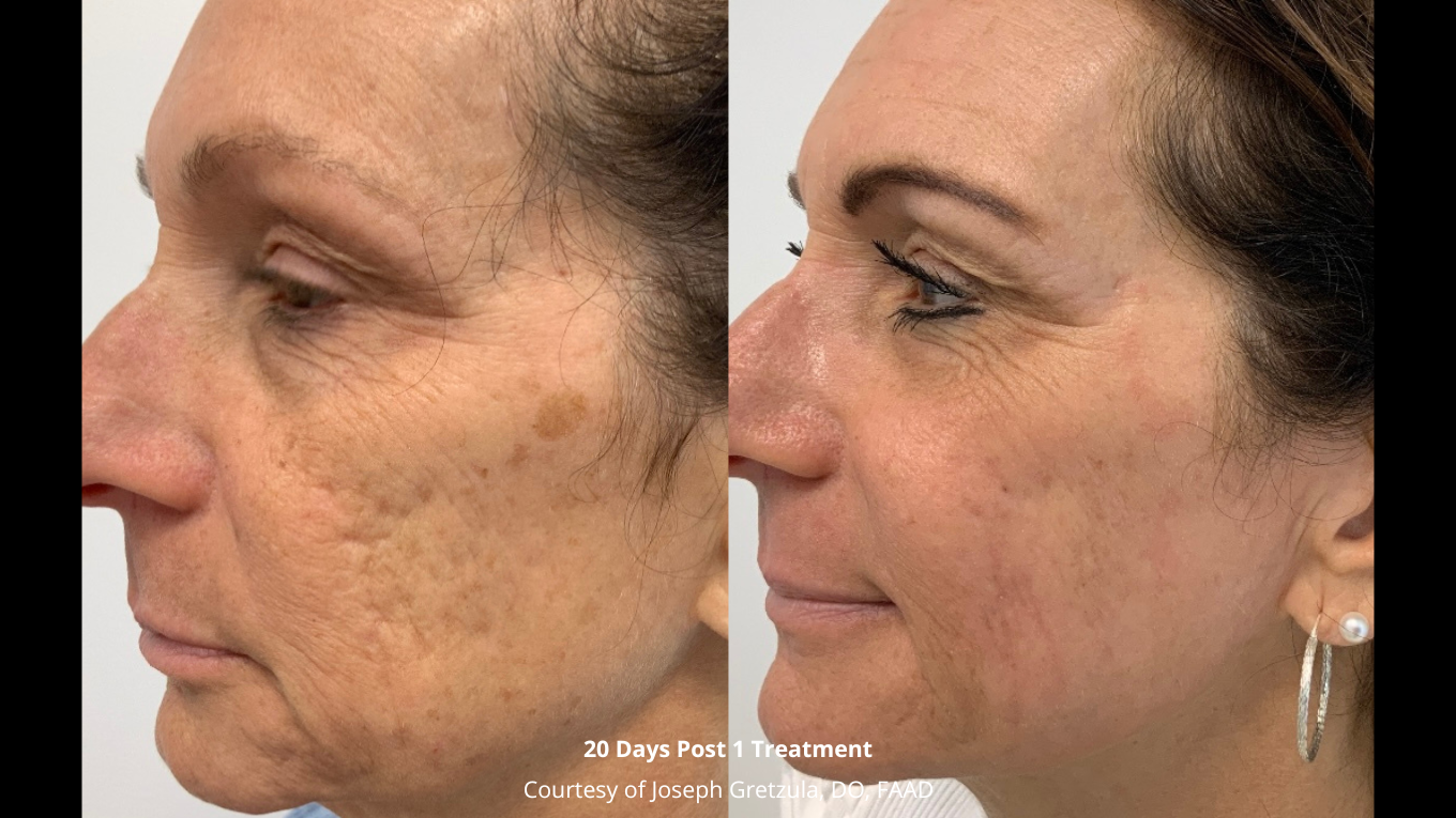Ultra Clear Ablative Laser Introduction