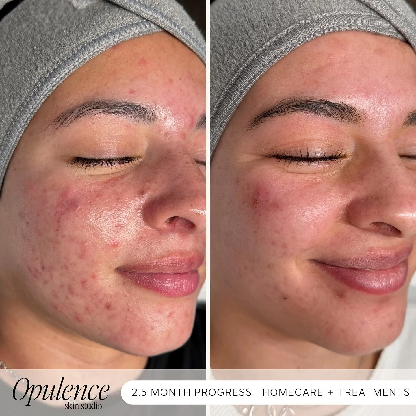 Acne doesn&rsquo;t have a fighting chance in my treatment room! 💥👊🏻

Look what only 2.5 months of treatments + homecare can accomplish!  Can&rsquo;t wait to see her progress in another 2.5! 🥹

Who else is ready to get clear skin? Let&rsquo;s do t