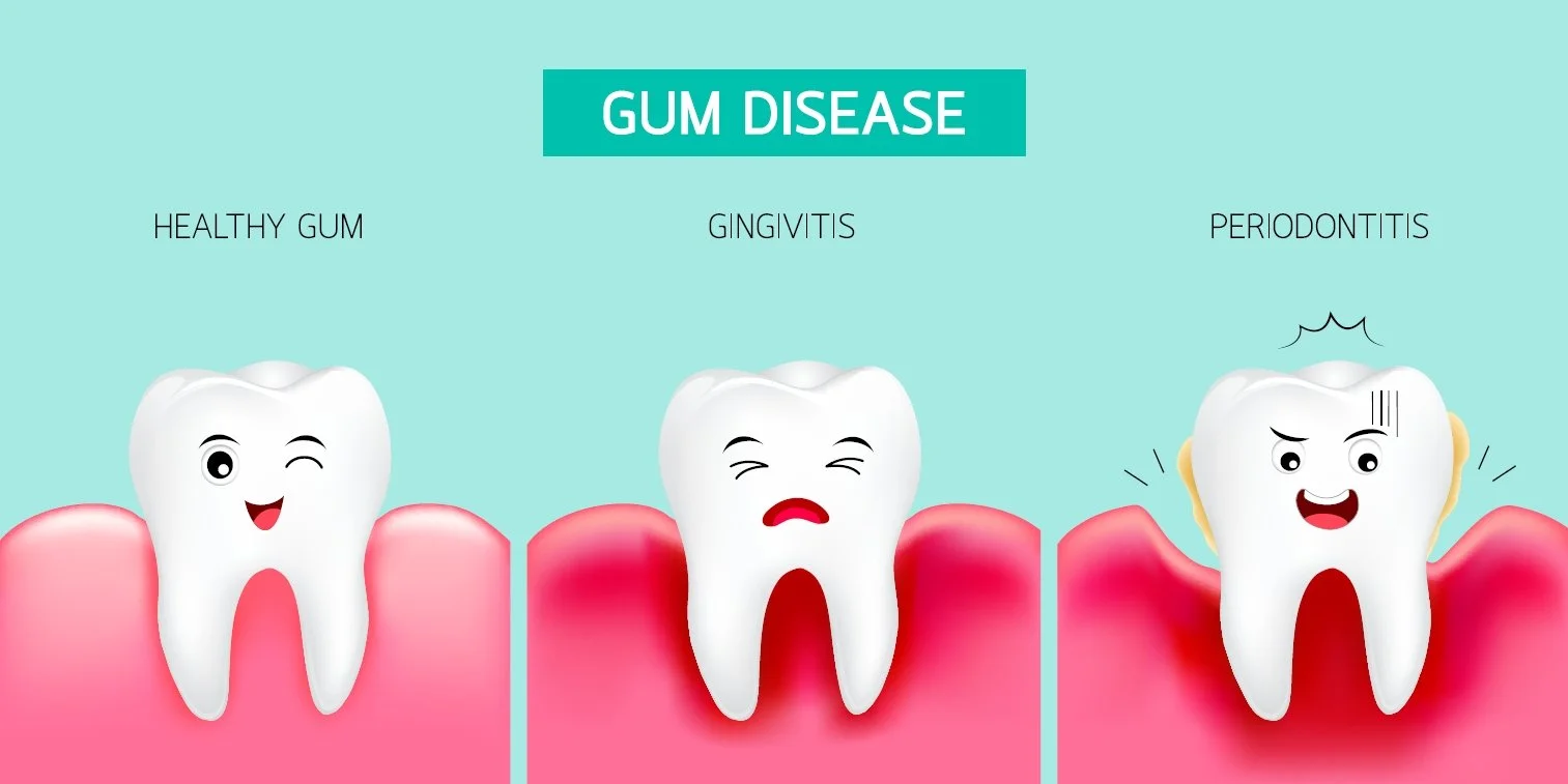 Are You at Risk for Periodontal Disease? Symptoms and Preventions