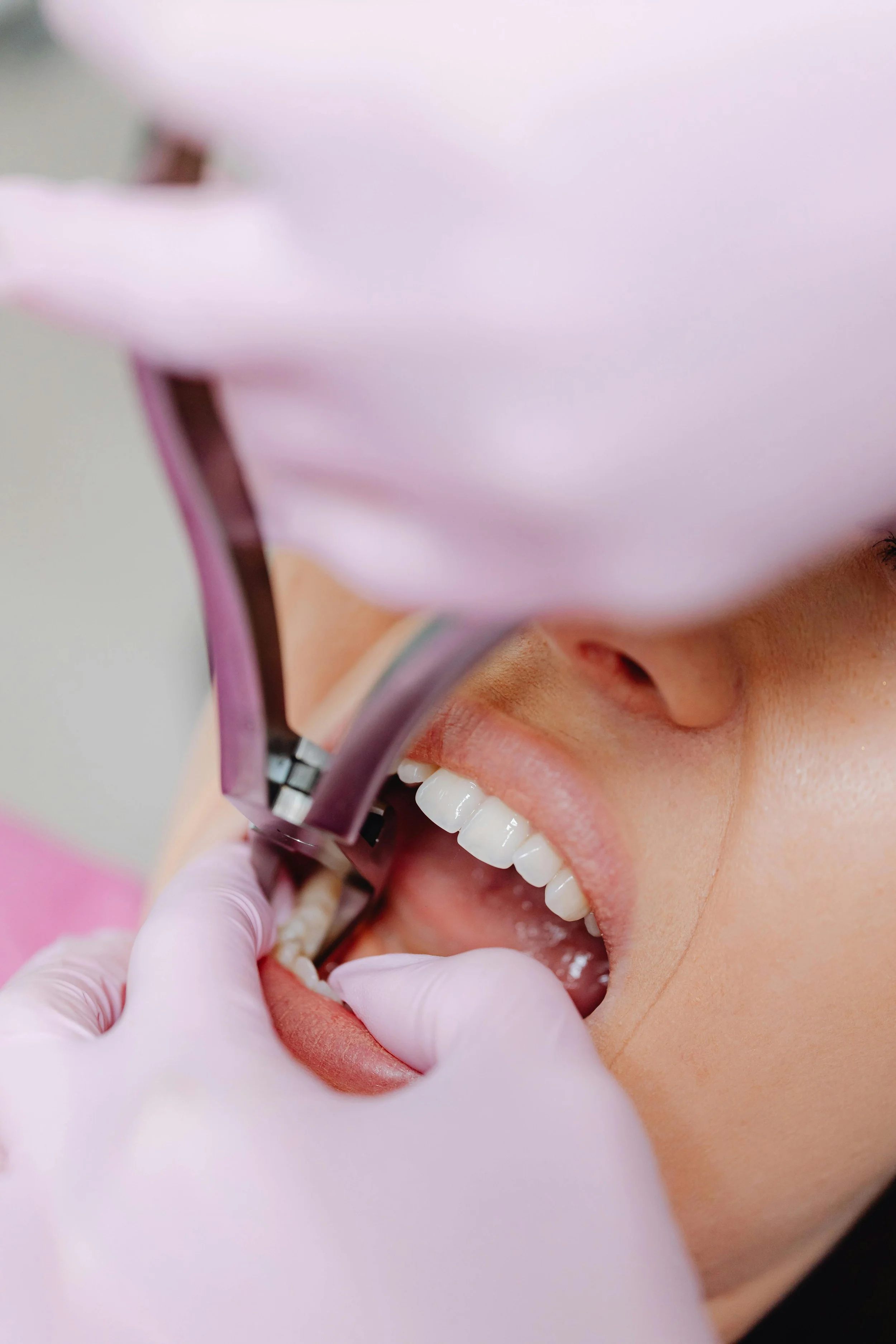 Understanding Teeth Extractions Options