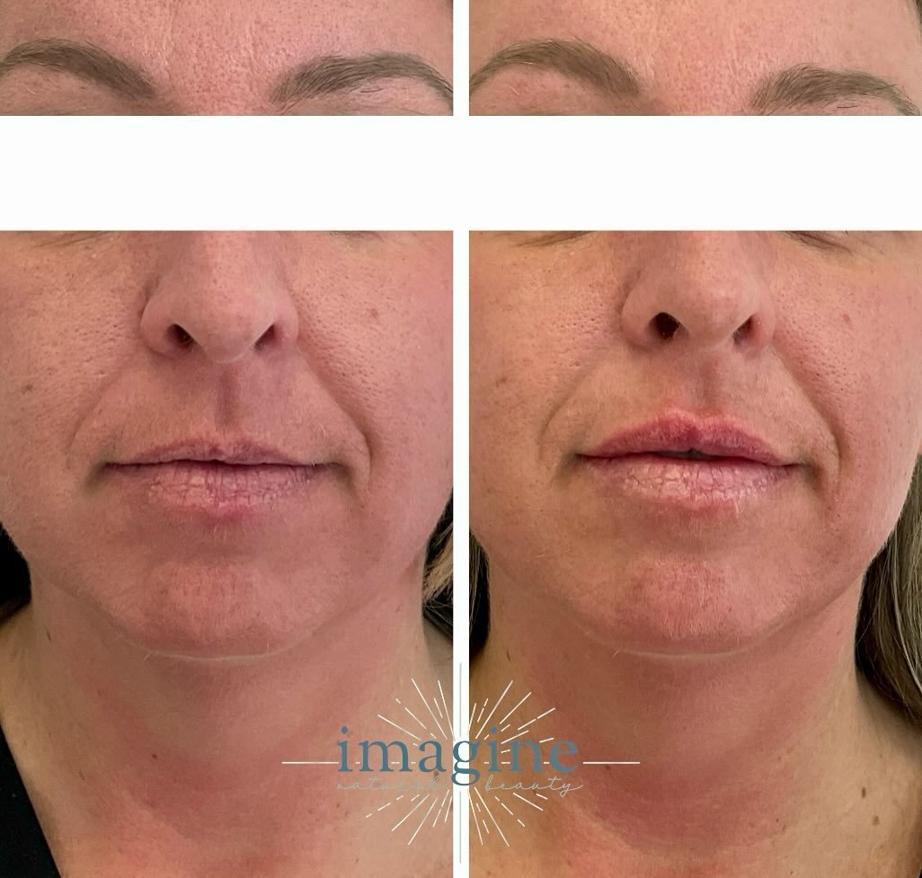 Another stunning and natural looking 👄 result! Remember, lip enhancements don&rsquo;t mean you have to look like a 🦆

#centraloregonbeauty #sistersoregon #natuarllips #refreshyourlook #glowupseason #TimelessBeauty #SpringFaceRefresh
#naturalaesthet