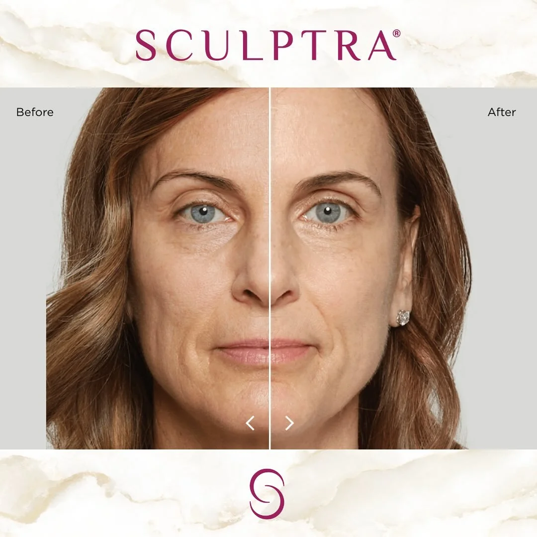 ☀️Summer SCULPTRA Special - Save $800 ☀️

Unlike hyaluronic acid fillers (which fill lines, wrinkles, and folds), Sculptra is the original FDA-approved collagen stimulator that can improve skin glow, tightness, and jawline contour for up to 2 years ?