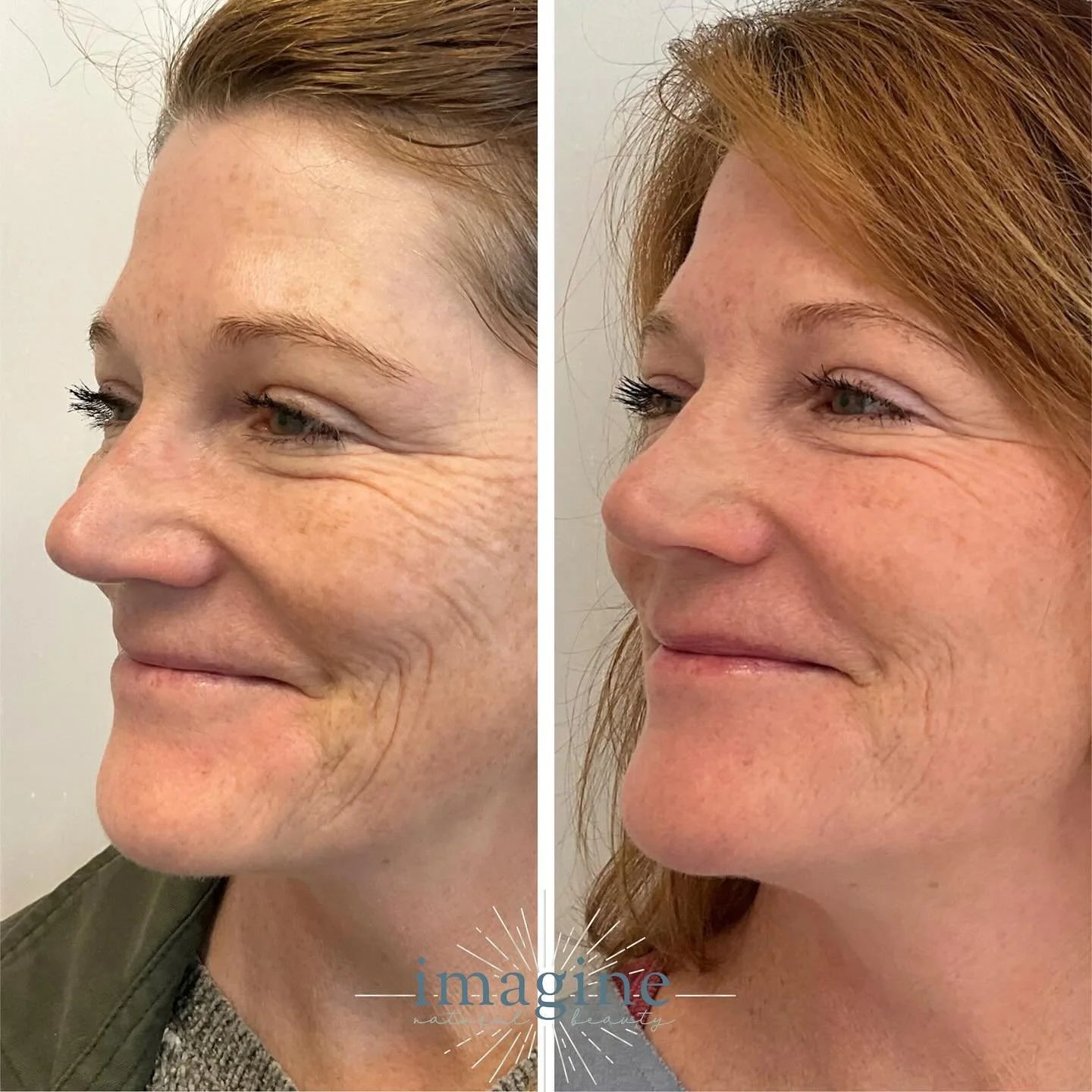 ✨Another STUNNING result with the Fern Technique 🌿

You guys, I know I keep saying it, but the results are INCREDIBLE. She is glowing! 

Call us today for your Fern Technique appointment📱

&bull;
&bull;
&bull;
#tomvaneijkacademy #fernpatterntechniq
