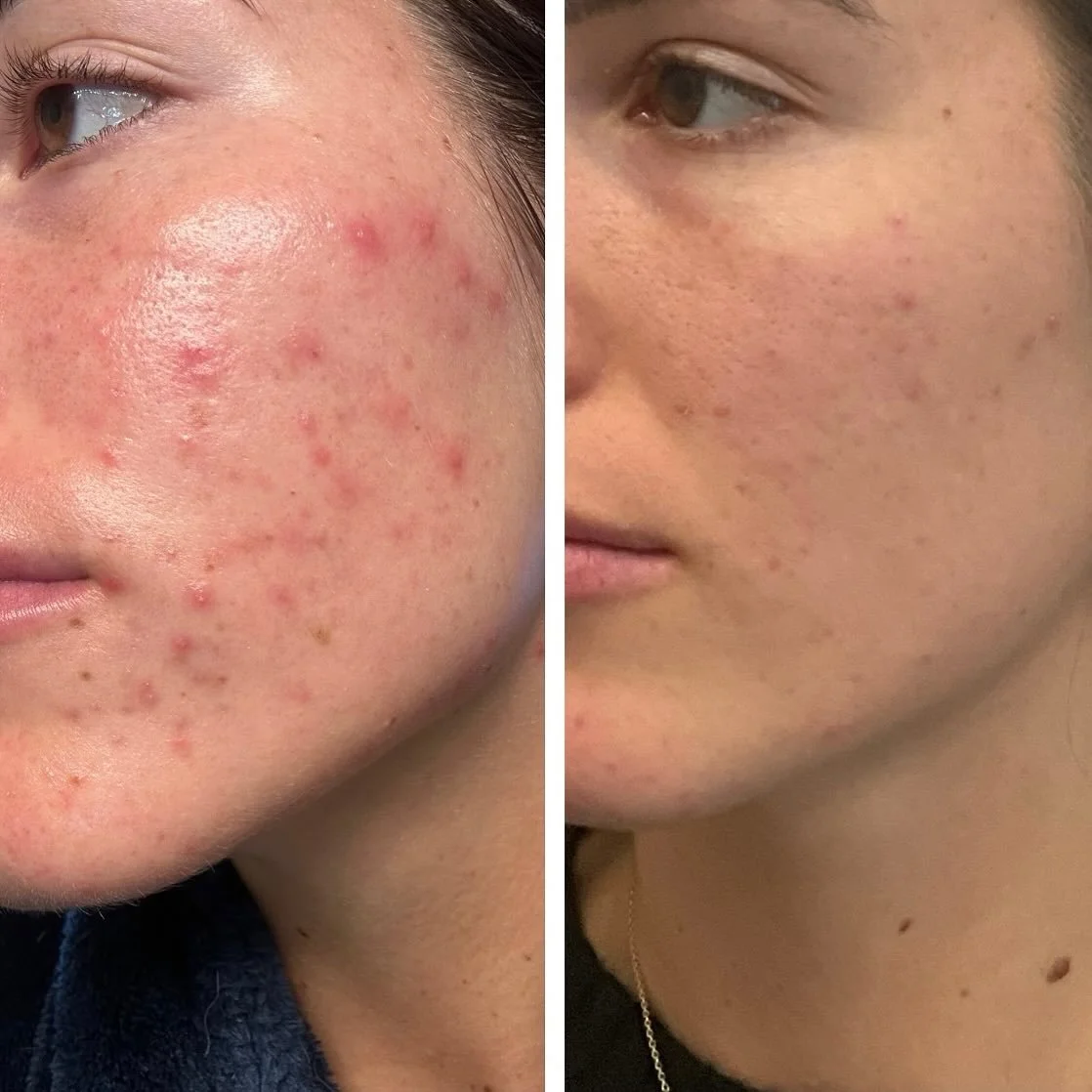Biojuve ✨ Plated ✨Factor Five ✨
What do all these have in common? AMAZING RESULTS. We know skin and how to help make yours shine ✨ 

&bull;
&bull;
&bull;

#biojuve #platedskinscience #skinhealth #factorfiveskincare #centraloregonbeauty #sistersoregon