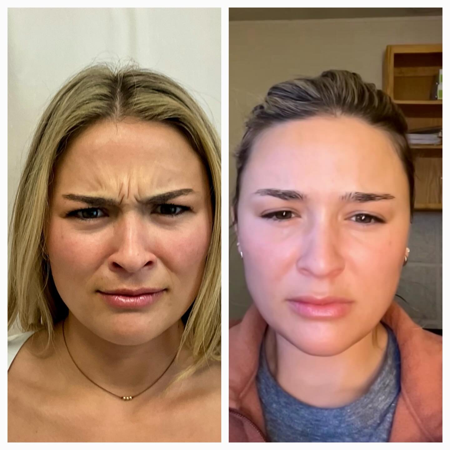 Gracie&rsquo;s First Tox - RESULTS ARE IN! ✨Before and afters on the scowl and scrunch two weeks later and we are thrilled with her results ✨ 💍 👏🏼

#tox #babytox #centraloregonbeauty #naturalaesthetics #weddingready