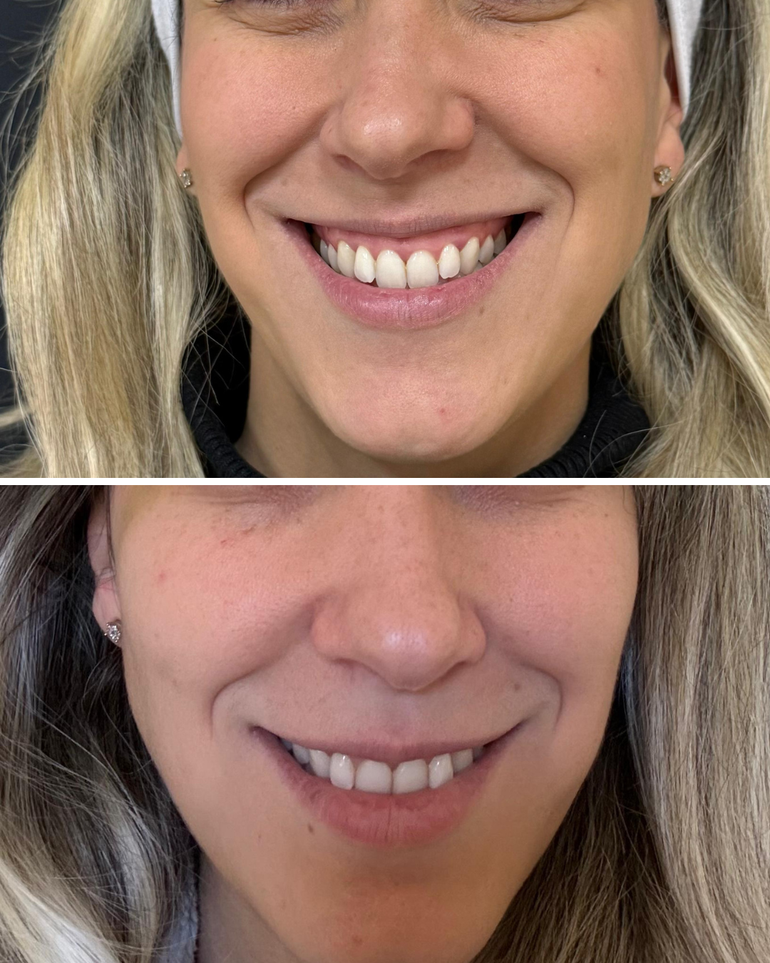 Close-up of a smiling woman with blonde hair, showing her teeth, in a before and after comparison of dental work.