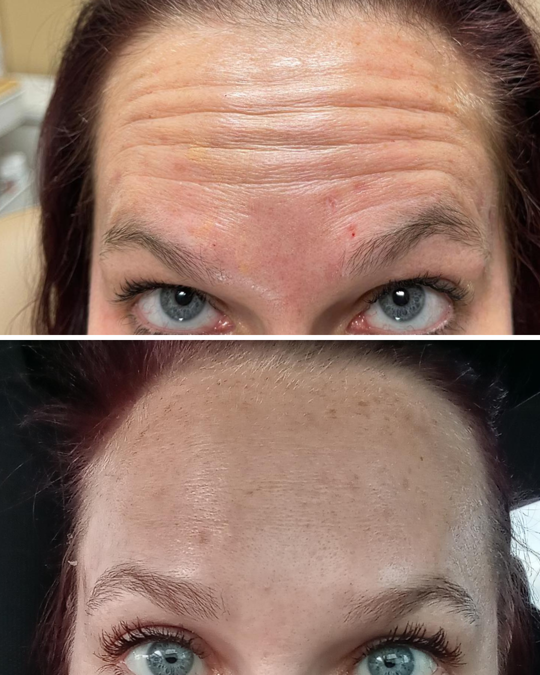 Comparison of a woman's forehead and eye area before and after skincare or treatment. The top image shows a forehead with visible wrinkles and uneven skin tone, while the bottom image shows a smoother, more even complexion with fewer wrinkles.
