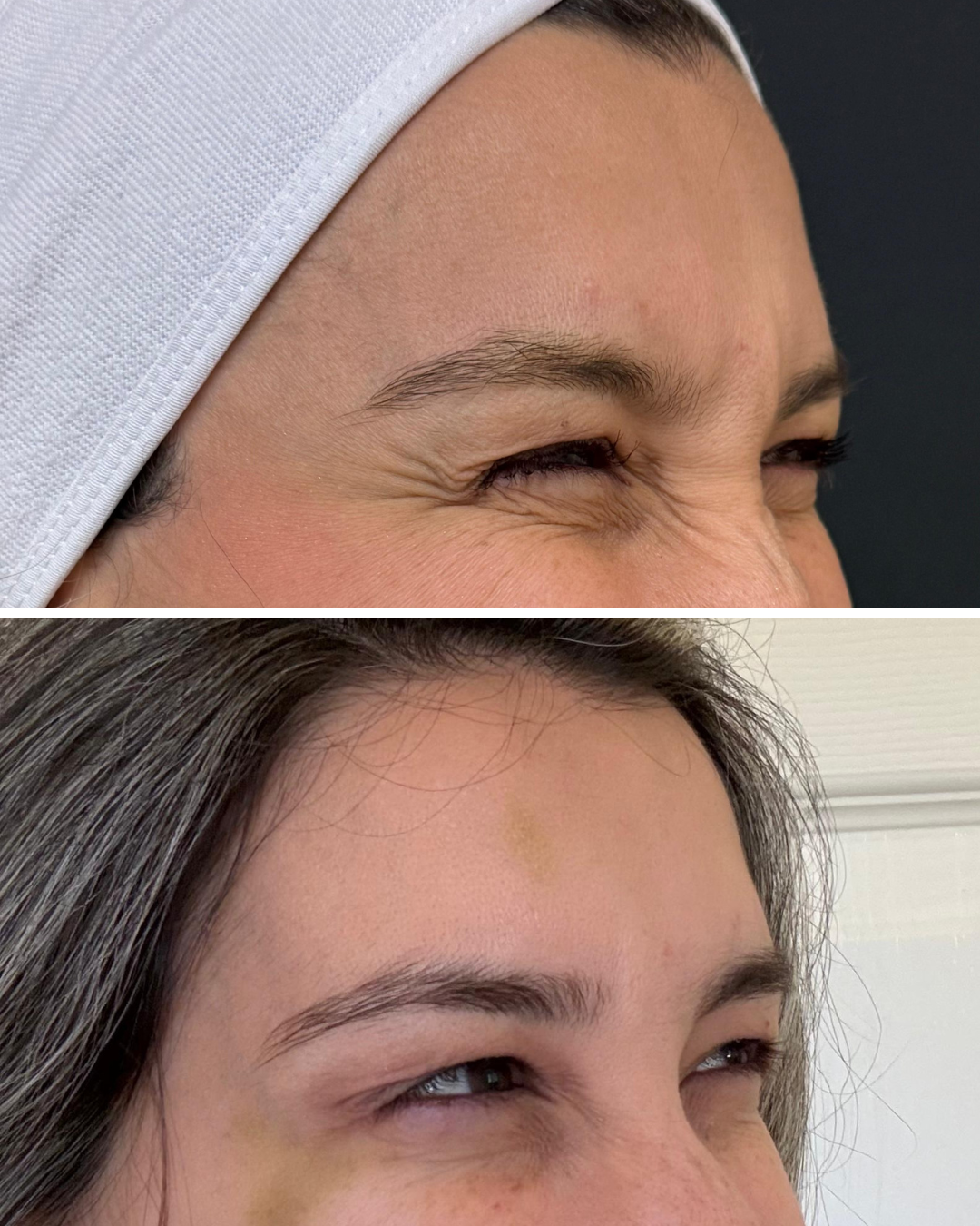 Comparison of a woman's face before and after a cosmetic treatment, showing reduced wrinkles around the eyes in the second image.