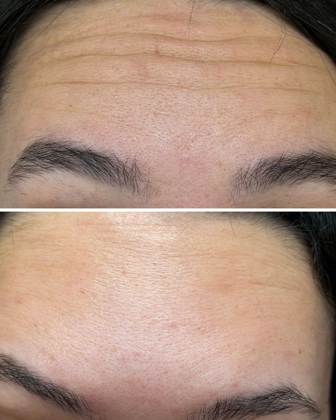 Close-up comparison of a person's forehead showing before and after skin treatment, with reduced redness, smoother texture, and minimized pores.