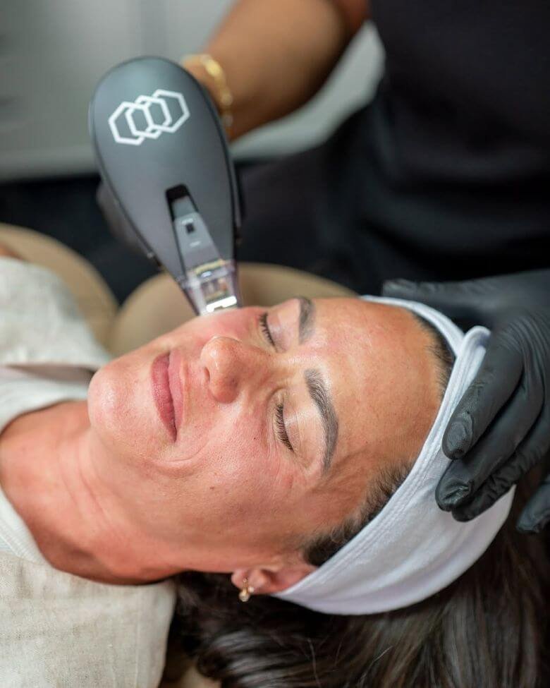 Morpheus8 Treatment in Bay Area, San Francisco