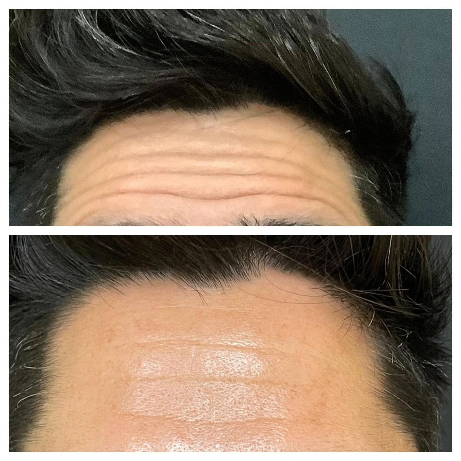 Comparison of forehead before and after skincare or cosmetic treatment showing reduction in wrinkles and smoother skin.
