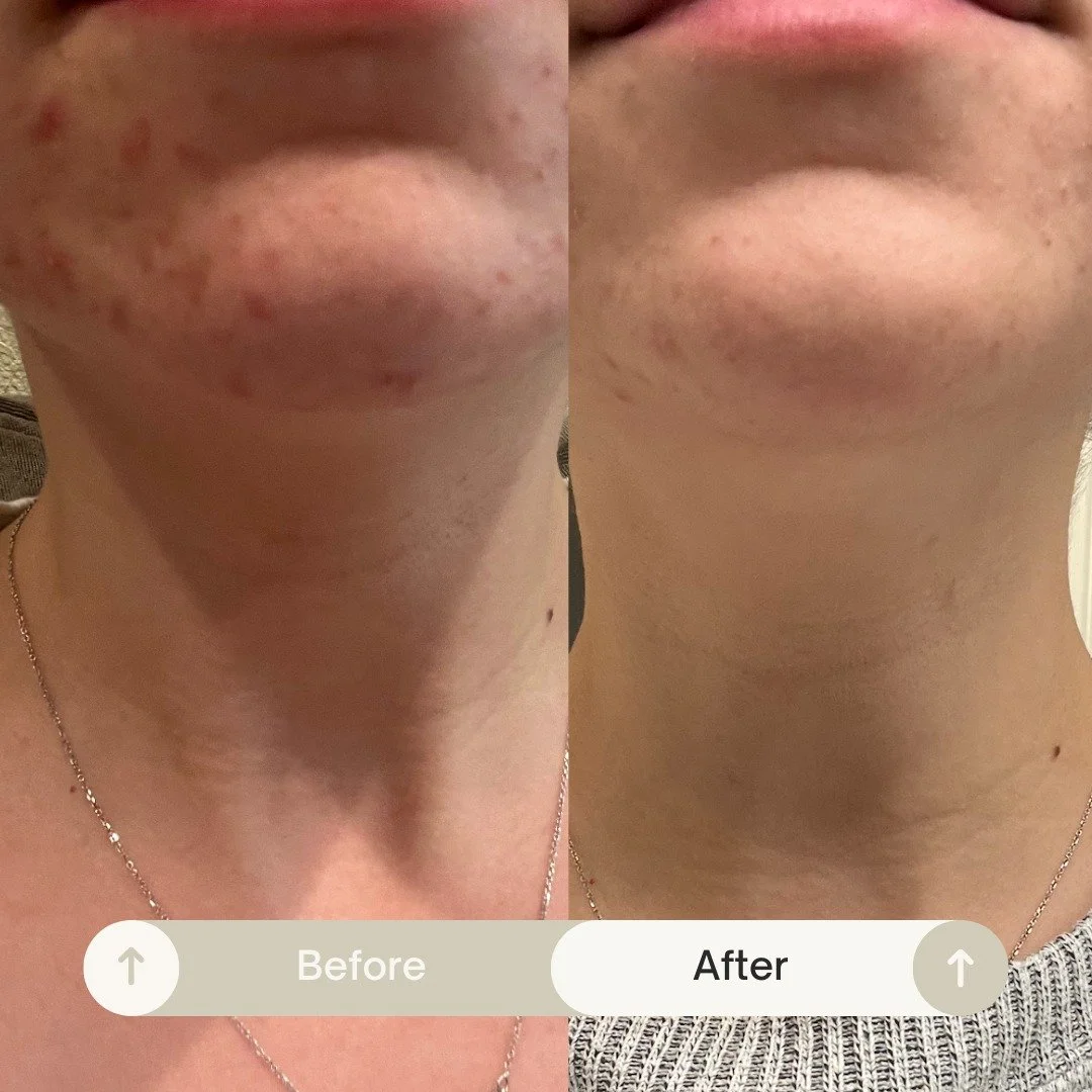 Another reminder that consistency pays off! 

This client has 

✨ invested in the right skincare products
✨ avoids pore cloggers, especially in her makeup
✨ removed all acne triggers from her lifestyle

Getting clear (&amp; staying clear) is an activ