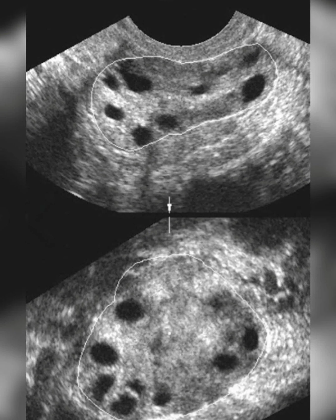 This ultrasound image demonstrates the classic ovarian appearance often associated with Polyendocrine Metabolic Ovarian Syndrome - PMOS better known as PCOS 🤔

What you&rsquo;re seeing:

* The multiple small black circular areas around the outer edg