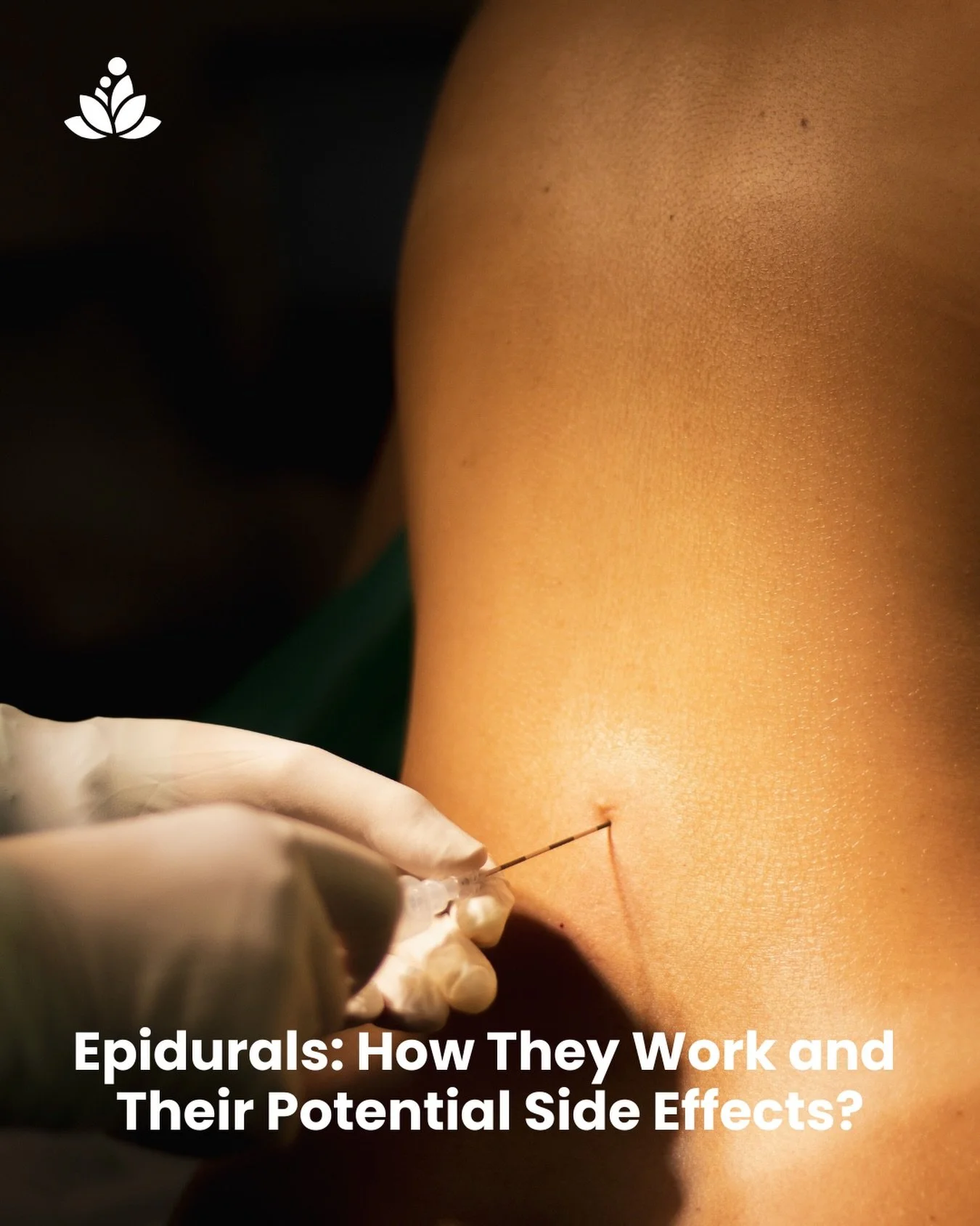 𝐖𝐡𝐚𝐭 𝐢𝐬 𝐚𝐧 𝐄𝐩𝐢𝐝𝐮𝐫𝐚𝐥?
An epidural is a type of pain relief used during labour. It works by blocking pain signals from the lower part of your body, helping to reduce or remove labour pain while allowing you to stay awake and involved in