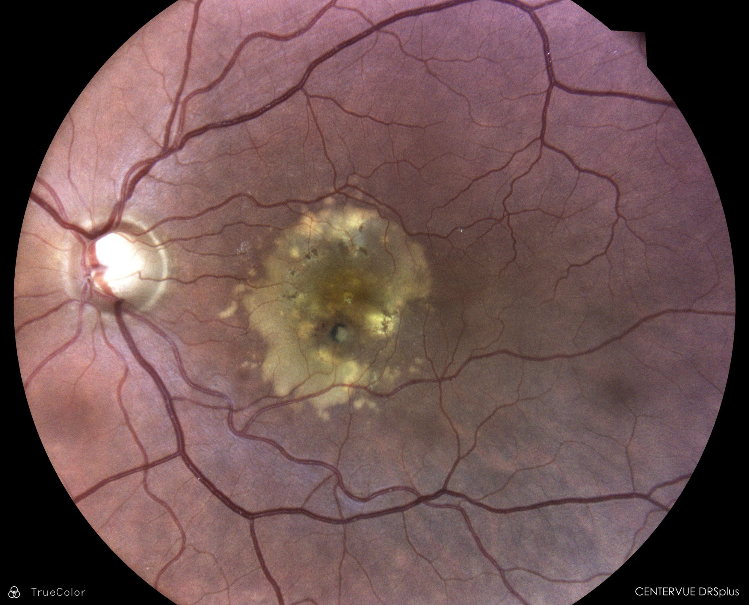 PATIENT_DEMO-5_Cataract_OS_central_color_09-30-2019_203556_03-19-2020_125303_204691-scaled.jpg