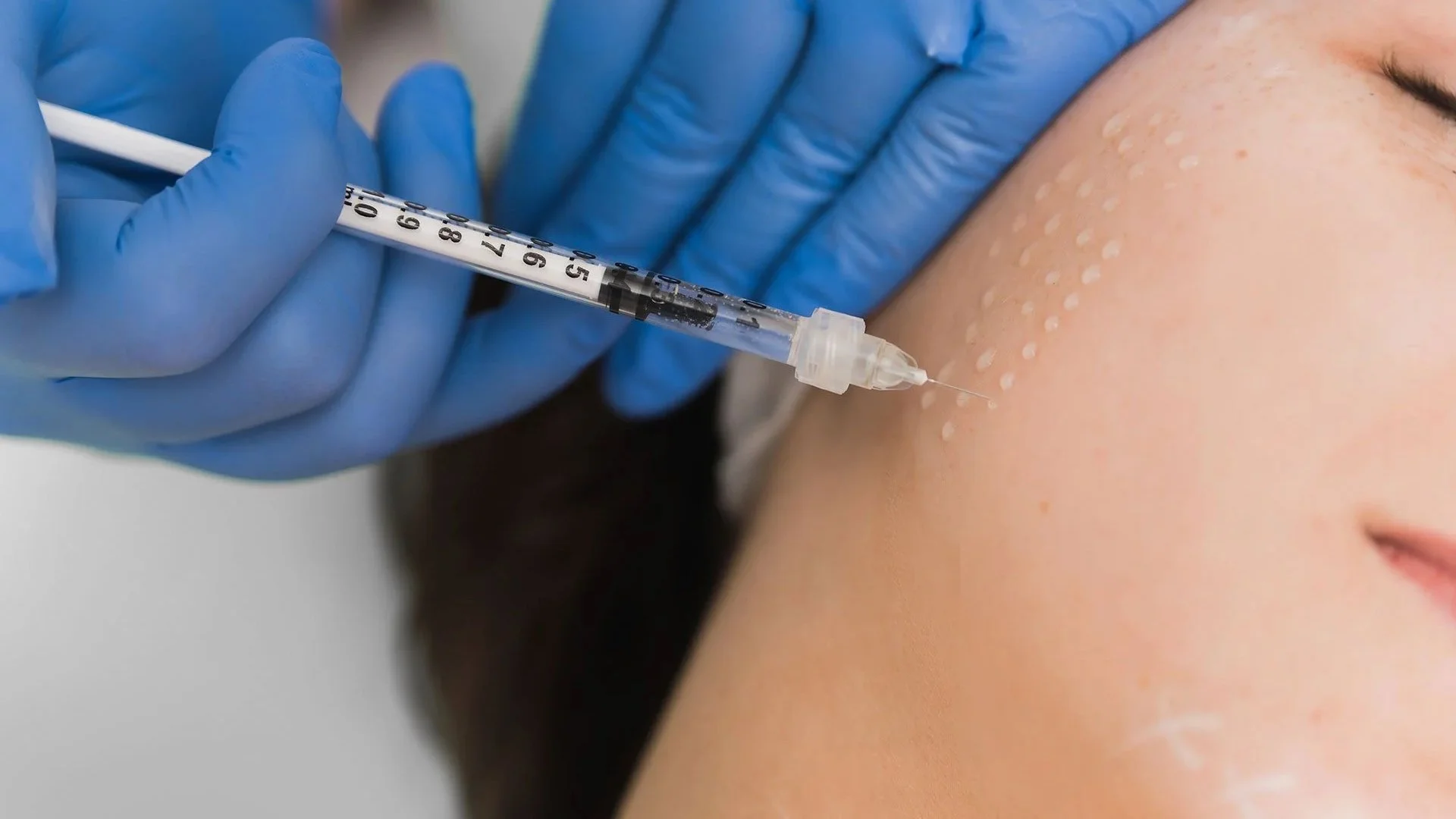 Injekciju metožu (mezoterapija un biorevitalizācija) pielietošana dažāduādas stāvokļu profilaksei un tās reģenerācijas procesiem.