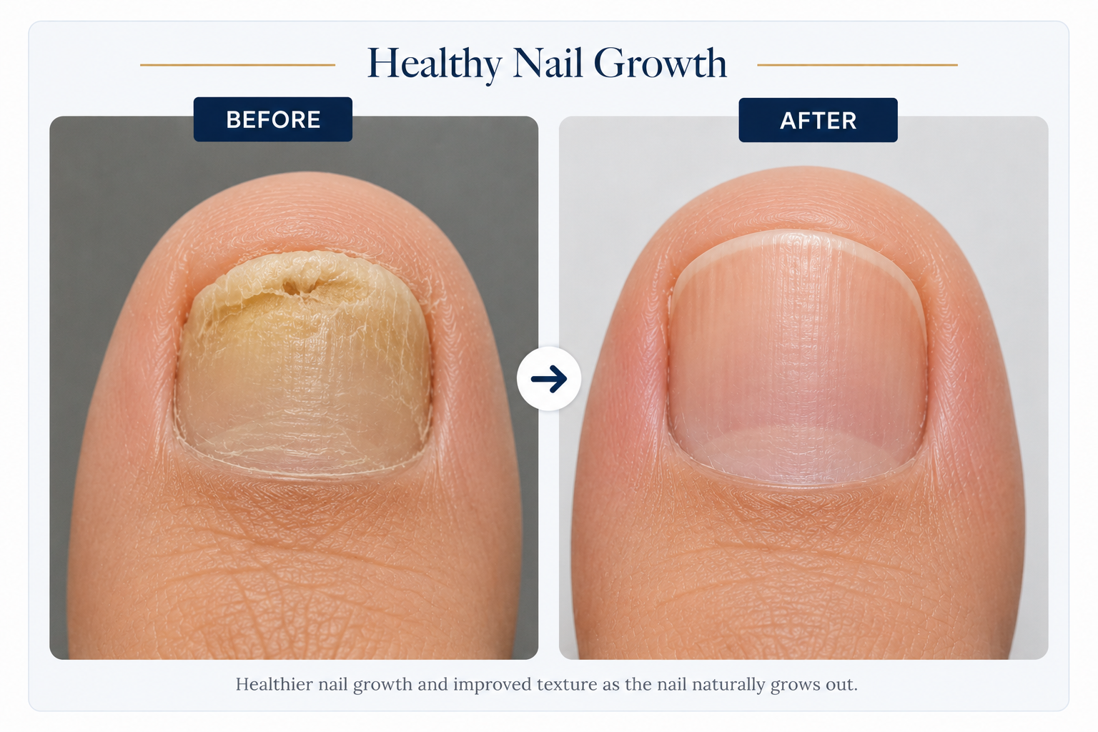 Healthy Nail Growth Before and After Treatment