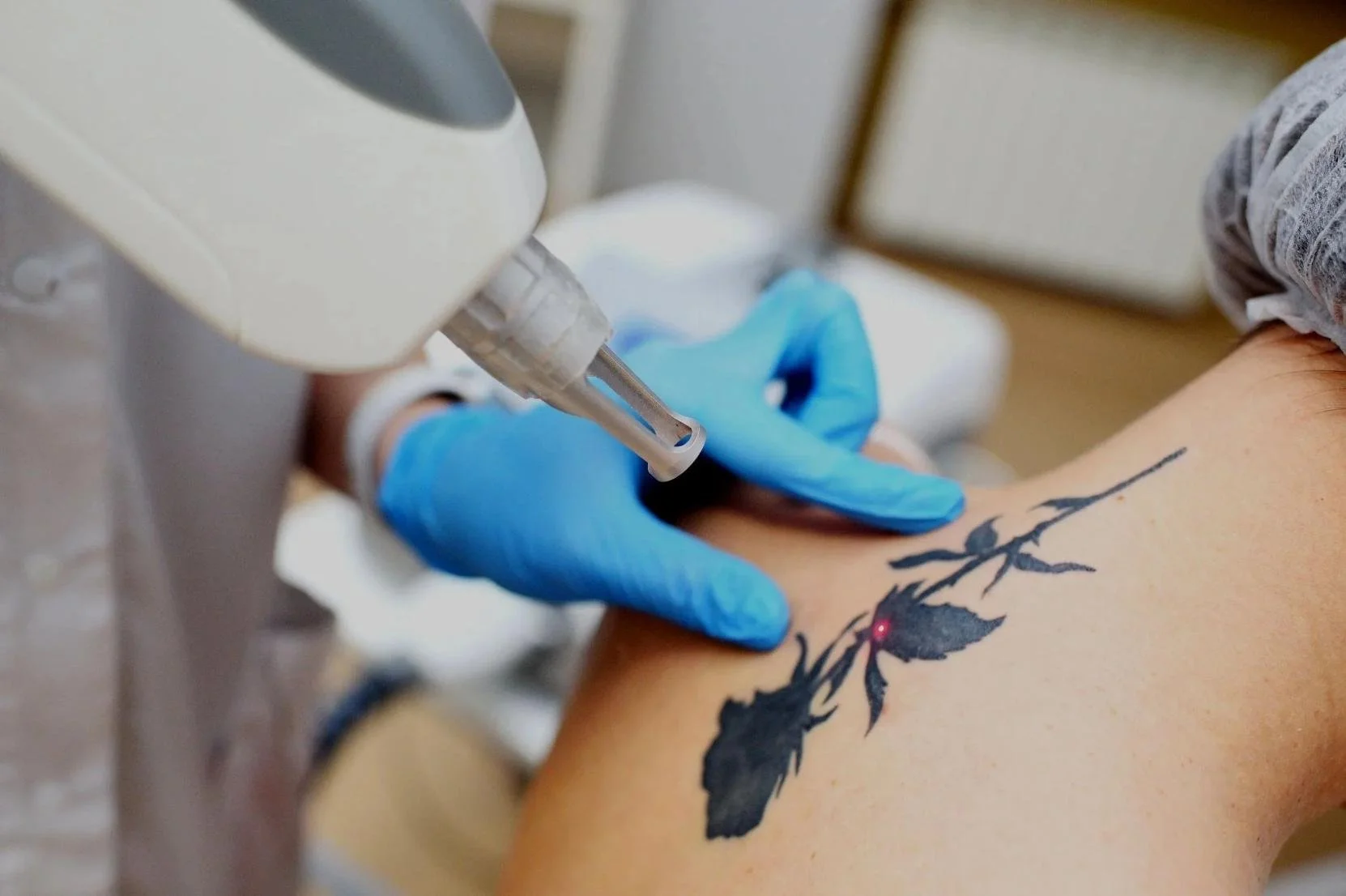 Laser Tattoo Removal