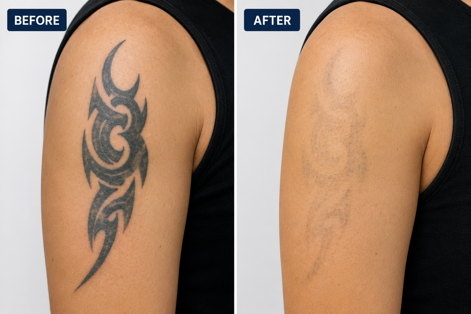 Laser Tattoo Removal