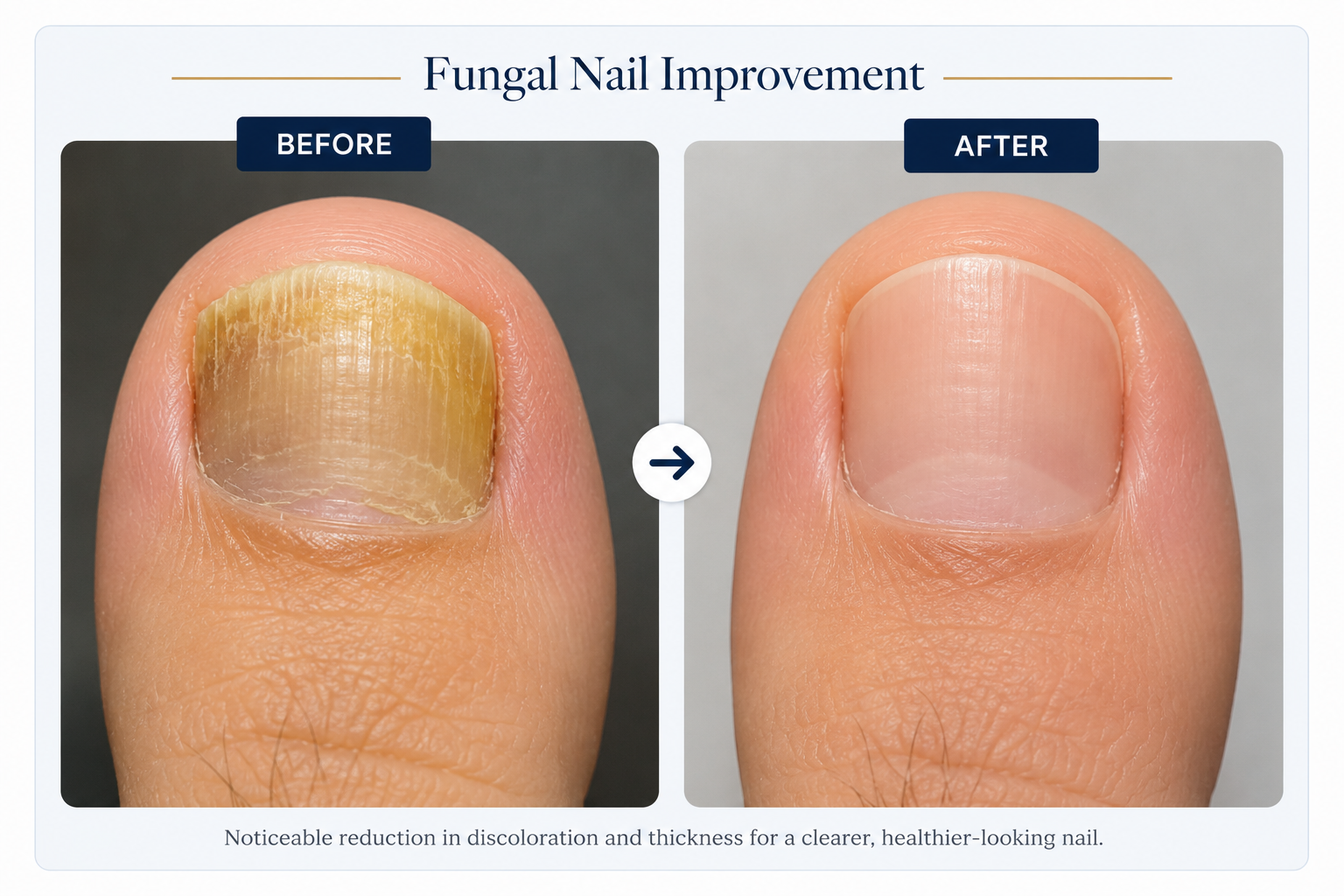 Before and After Result of Fungal Nail Treatment